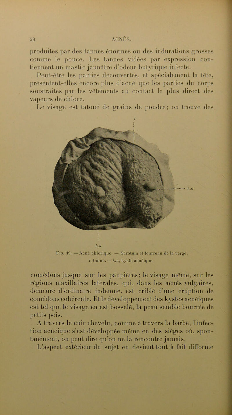 produites par des tannes énormes ou des indurations grosses comme le pouce. Les tannes vidées par expression con- tiennent un mastic jaunAtre d’odeur butyrique infecte. Peut-être les parties découvertes, et spécialement la tête, présentent-elles encore plus d’acné que les parties du corps soustraites par les vêtements au contact le plus direct des vapeurs de chlore. Le visage est tatoué de grains de poudre; on trouve des l h. a Fig. 19. — Acné chlorique. — Scrotum et fourreau de la verge. t, tanne. — k.a, kyste acnéique. comédons jusque sur les paupières; le visage même, sur les régions maxillaires latérales, qui, dans les acnés vulgaires, demeure d’ordinaire indemne, est criblé d'une éruption de comédons cohérente. Et le développement des kystes acnéiques est tel que le visage en est bosselé, la peau semble bourrée de petits pois. A travers le cuir chevelu, comme à travers la barbe, l'infec- tion acnéique s’est développée même en des sièges où, spon- tanément, on peut dire qu’on ne la rencontre jamais. L’aspect extérieur du sujet en devient tout à fait difforme