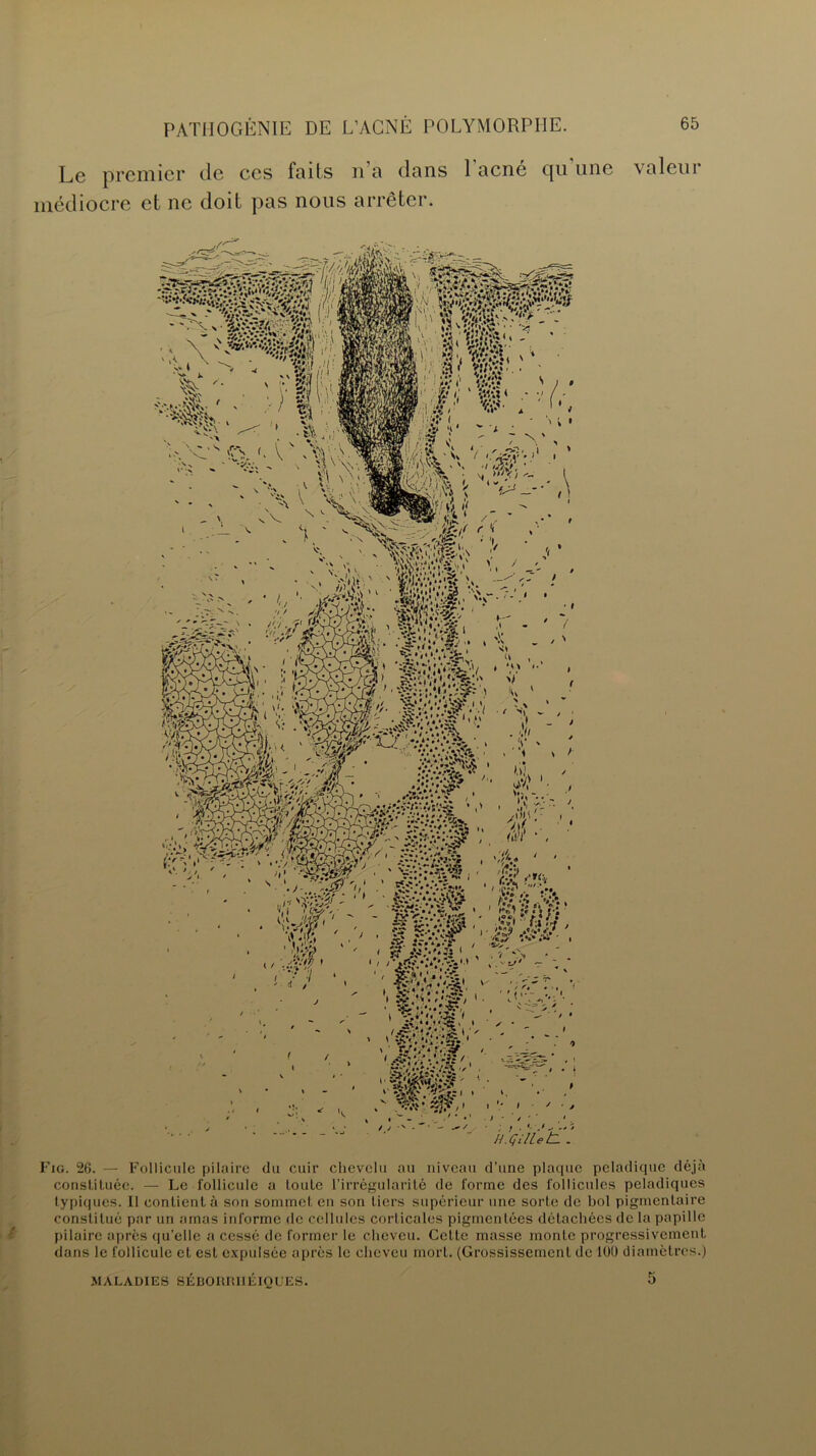 Le premier de ces faits n a dans 1 acné cju une valeur médiocre et ne doit pas nous arrêter. Fig. 26. — Follicule pilaire du cuir chevelu au niveau d’une plaque peladique déjà constituée. — Le follicule a toute l’irrégularité de forme des follicules peladiques typiques. Il contient à son sommet en son tiers supérieur une sorte de bol pigmentaire constitué par un amas informe de cellules corticales pigmentées détachées de la papille pilaire après qu’elle a cessé de former le cheveu. Cette masse monte progressivement dans le follicule et est expulsée après le cheveu mort. (Grossissement de 100 diamètres.) MALADIES SÉBORRHÉIQUES