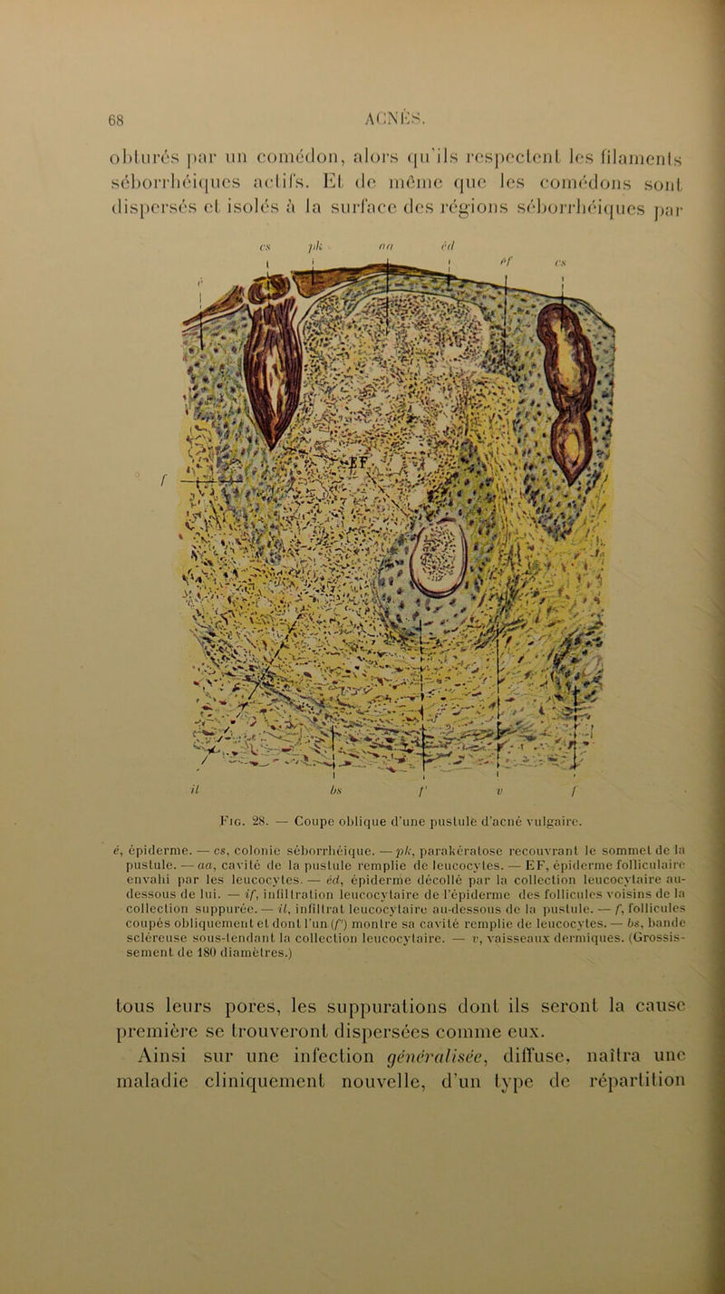 obturés par un comédon, alors qu'ils respectent les filaments séborrhéiques actifs. Et de même que les comédons sont dispersés et isolés à la surface des régions séborrhéiques pai- es pk nu cri Fig. 28. — Coupe oblique d’une pustule d’acné vulgaire. é, épiderme. — es, colonie séborrhéique. —pk, parakératose recouvrant le sommet de la pustule. — aa, cavité de la pustule remplie de leucocytes. — EF, épiderme folliculaire envahi par les leucocytes. — cd, épiderme décollé par la collection leucocytaire au- dessous de lui. — if, infiltration leucocytaire de l’épiderme des follicules voisins de la collection suppurée. — il, infiltrât leucocytaire au-dessous de la pustule. — f, follicules coupés obliquement et dont l’un (f) montre sa cavité remplie de leucocytes. — bs, bande scléreuse sous-tendant la collection leucocytaire. — v, vaisseaux dermiques. (Grossis- sement de 180 diamètres.) tous leurs pores, les suppurations dont ils seront la cause première se trouveront dispersées comme eux. Ainsi sur une infection généralisée, diffuse, naîtra une maladie cliniquement nouvelle, d'un type de répartition