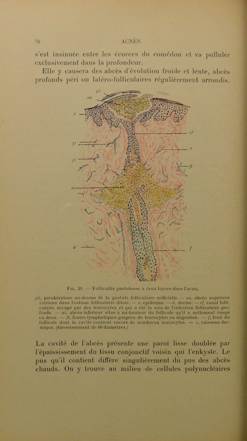 s’est insinuée entre les écorces du comédon et va pulluler exclusivement dans la profondeur. Elle y causera des abcès d’évolution froide et lente, abcès profonds péri ou latéro-lblliculaires régulièrement arrondis. •v*.< V!»* O ) ; / m, 3 àâ $ A  3Ê& Fig. 29. — Folliculite pustuleuse à deux foyers dans l’acné. pk, parakératose au-dessus de la pustule folliculaire orificielle. — as, abcès supérieur contenu dans l’ostium folliculaire dilaté. — é, épiderme. — d, derme. — cf, canal folli- culaire occupé par des leucocytes et qui a été la voie de l’infection folliculaire pro- fonde. — ai, abcès inférieur situé à mi-hauteur du follicule qu’il a nettement coupé en deux. — fl, fentes lymphatiques gorgées de leucocytes en migration. — f, fond du follicule dont la cavité contient encore de nombreux leucocytes. — v, vaisseau der- mique. (Grossissement de 60 diamètres.) La cavité de l’abcès présente une paroi lisse doublée par l’épaississement du tissu conjonctif voisin qui l’enkyste. Le pus qu’il contient diffère singulièrement du pus des abcès chauds. On y trouve au milieu de cellules polynucléaires