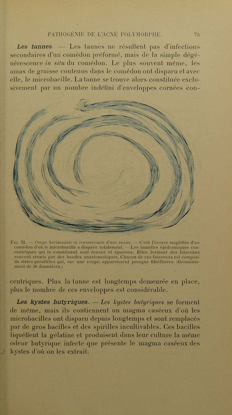 Les tannes. — Les tannes ne résultent pas d'infections secondaires d’un comédon préformé, mais de la simple dégé- nérescence in situ du comédon. Le plus souvent même, les amas de graisse contenus dans le comédon ont disparu et avec elle, le microbacille. La tanne se trouve alors constituée exclu- sivement par un nombre indéfini d’enveloppes cornées con- Fig. 51. — Coupe horizontale et transversale d'une tanne. — C’esL l’écorce amplifiée d’un comédon d’où le microbacille a disparu totalement. — Les lamelles épidermiques con- centriques qui la constituent sonL denses et épaisses. Elles forment des faisceaux souvent réunis par des bandes anastomotiques. Chacun de ces faisceaux est composé de stries parallèles qui, sur une coupe, apparaissent presque librillaires. (Grossisse- ment de 50 diamètres.) centriques. Plus la tanne est longtemps demeurée en place, plus le nombre de ces enveloppes est considérable. Les kystes butyriques. — Les kystes butyriques se forment de même, mais ils contiennent un magma caséeux d’où les microbacilles ont disparu depuis longtemps et sont remplacés par de gros bacilles et des spirilles incultivables. Ces bacilles liquéfient la gélatine et produisent dans leur culture la même odeur butyrique infecte que présente le magma caséeux des kystes d’où on les extrait.