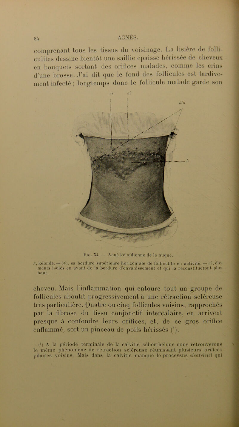 comprenant tous les tissus du voisinage. La lisière de folli- culites dessine bientôt une saillie épaisse hérissée de cheveux en bouquets sortant des orilices malades, comme les crins d’une brosse. J’ai dit que le fond des follicules est tardive- ment infecté; longtemps donc le follicule malade garde son ci ci le Fjg. 54. — Acné kéloïdienne de la nuque. k, kéloïde. — bfa. sa bordure supérieure horizontale de folliculite en activité. — ri, élé- ments isolés en avant de la bordure d’envahissement et qui la reconstitueront plus haut. cheveu. Mais l'inflammation qui entoure tout un groupe de follicules aboutit progressivement à une rétraction scléreuse très particulière. Quatre ou cinq follicules voisins, rapprochés par la fibrose du tissu conjonctif intercalaire, en arrivent presque à confondre leurs orifices, et, de ce gros orifice enflammé, sort un pinceau de poils hérissés ('). (') A la période terminale de la calvitie séborrhéique nous retrouverons le même phénomène de rétraction scléreuse réunissant plusieurs orifices pilaires voisins. Mais dans la calvitie manque le processus cicatriciel qui