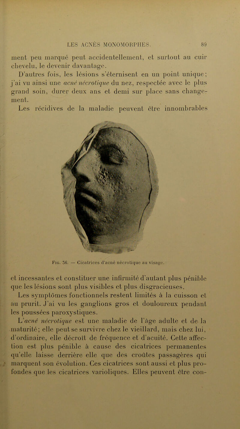 ment peu marqué peut accidentellement, et surtout au cuir chevelu, le devenir davantage. D’autres fois, les lésions s’éternisent en un point unique; j'ai vu ainsi une acné nécrotique du nez, respectée avec le plus grand soin, durer deux ans et demi sur place sans change- ment. Les récidives de la maladie peuvent être innombrables Fio. 56. — Cicalrices d’acné nécrolique au visage. et incessantes et constituer une infirmité d’autant plus pénible que les lésions sont plus visibles et plus disgracieuses. Les symptômes fonctionnels restent limités à la cuisson et au prurit. J’ai vu les ganglions gros et douloureux pendant les poussées paroxystiques. L'acné nécrotique est une maladie de l’âge adulte et de la maturité; elle peut se survivre chez le vieillard, mais chez lui, d’ordinaire, elle décroît de fréquence et d’acuité. Cette affec- tion est plus pénible à cause des cicatrices permanentes qu’elle laisse derrière elle que des croûtes passagères qui marquent son évolution. Ces cicatrices sont aussi et plus pro- fondes que les cicatrices varioliques. Elles peuvent être cou-