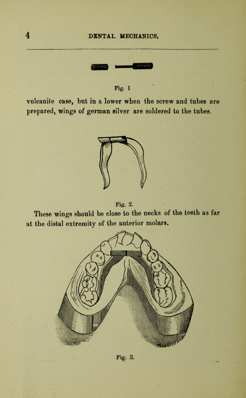 Fig. 1 vulcanite case, but in a lower when the screw and tubes are prepared, wings of german silver are soldered to the tubes. These wings should be close to the necks of the teeth as far at the distal extremity of the anterior molars. Fig. 3.