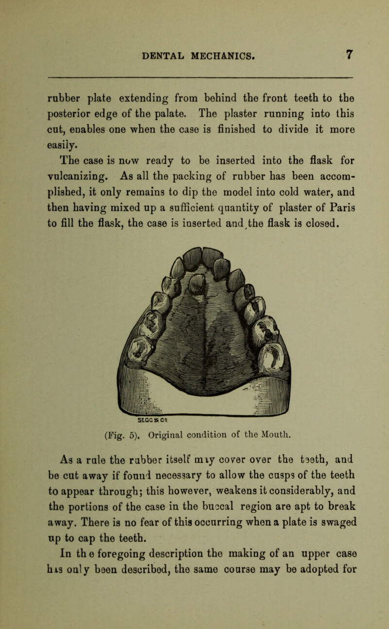 rubber plate extending from behind the front teeth to the posterior edge of the palate. The plaster running into this cut, enables one when the case is finished to divide it more easily. The case is now ready to be inserted into the flask for vulcanizing. As all the packing of rubber has been accom- plished, it only remains to dip the model into cold water, and then having mixed up a sufficient quantity of plaster of Paris to fill the flask, the case is inserted and The flask is closed. 5EGCKCS (Fig. 5). Original condition of the Mouth. As a rule the rubber itself any cover over the teeth, and be cut away if found necessary to allow the cusps of the teeth to appear through; this however, weakens it considerably, and the portions of the case in the buccal region are apt to break away. There is no fear of this occurring when a plate is swaged up to cap the teeth. In th e foregoing description the making of an upper case his only been described, the same course may be adopted for