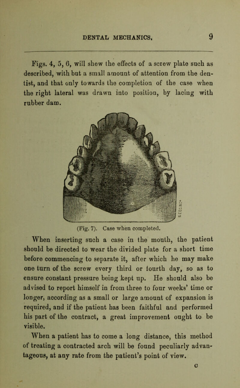 Figs. 4, 5, 6, will shew the effects of a screw plate such as described, with but a small amount of attention from the den- tist, and that only towards the completion of the case when the right lateral was drawn into position, by lacing with rubber dam. (Fig. 7). Case when completed. When inserting such a case in the mouth, the patient should be directed to wear the divided plate for a short time before commencing to separate it, after which he may make one turn of the screw every third or lourth day, so as to ensure constant pressure being kept up. He should also be advised to report himself in from three to four weeks’ time or longer, according as a small or large amount of expansion is required, and if the patient has been faithful and performed his part of the contract, a great improvement ought to be visible. When a patient has to come a long distance, this method of treating a contracted arch will be found peculiarly advan- tageous, at any rate from the patient’s point of view. c