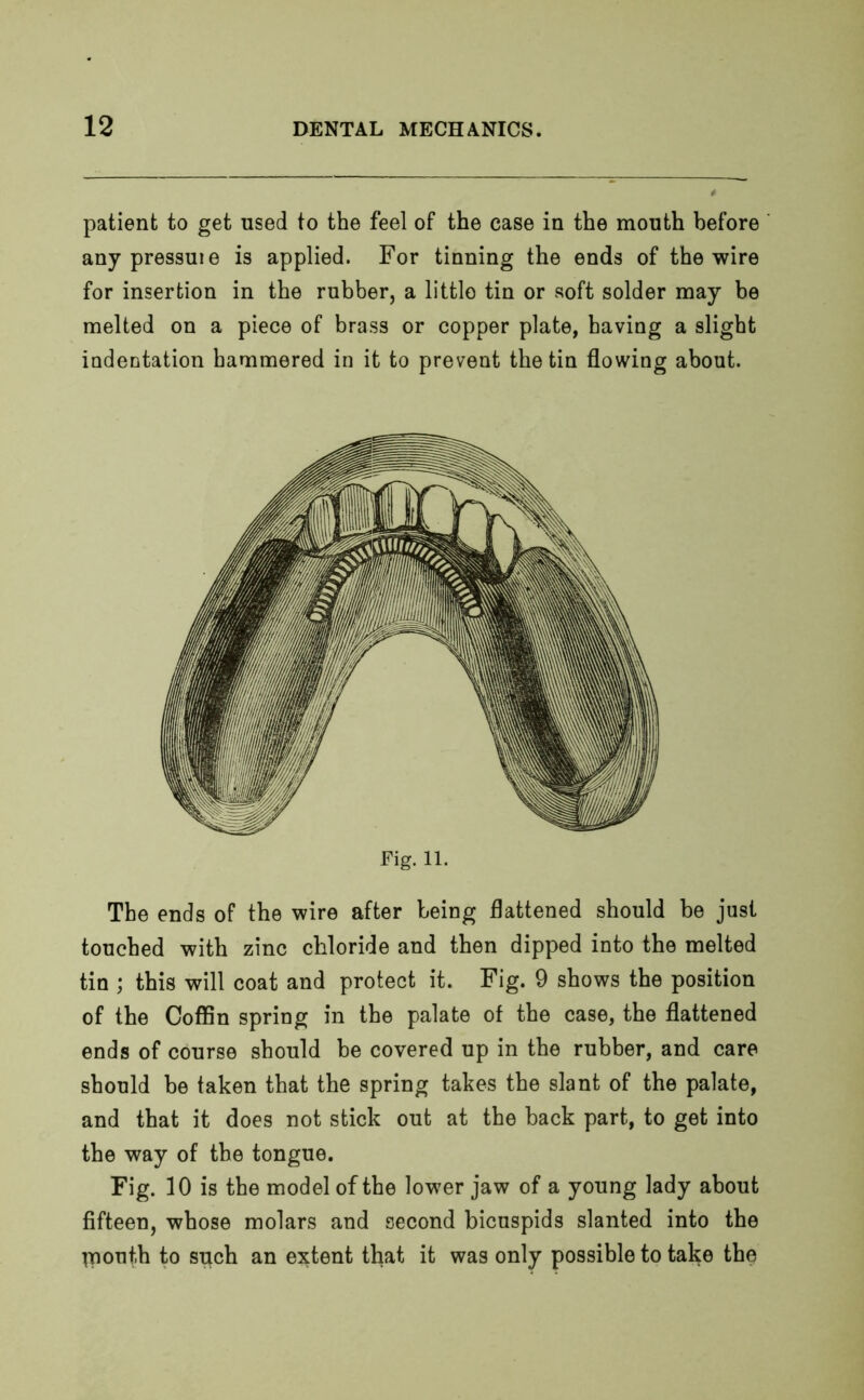 patient to get used to the feel of the case in the mouth before any pressuie is applied. For tinning the ends of the wire for insertion in the rubber, a littlo tin or soft solder may be melted on a piece of brass or copper plate, having a slight indentation hammered in it to prevent the tin flowing about. The ends of the wire after being flattened should be just touched with zinc chloride and then dipped into the melted tin ; this will coat and protect it. Fig. 9 shows the position of the Coffin spring in the palate of the case, the flattened ends of course should be covered up in the rubber, and care should be taken that the spring takes the slant of the palate, and that it does not stick out at the back part, to get into the way of the tongue. Fig. 10 is the model of the lower jaw of a young lady about fifteen, whose molars and second bicuspids slanted into the jnout.h to such an extent that it was only possible to take the