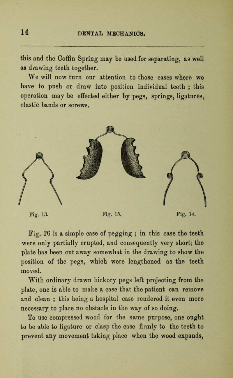 this and the Coffin Spring may be used for separating, as well as drawing teeth together. We will now turn our attention to those cases where we have to push or draw into position individual teeth ; this operation may be effected either by pegs, springs, ligatures, elastic bands or screws. Fig. lfi is a simple case of pegging ; in this case the teeth were only partially erupted, and consequently very short; the plate has been cut away somewhat in the drawing to show the position of the pegs, which were lengthened as the teeth moved. With ordinary drawn hickory pegs left projecting from the plate, one is able to make a case that the patient can remove and clean ; this being a hospital case rendered it even more necessary to place no obstacle in the way of so doing. To use compressed wood for the same purpose, one ought to be able to ligature or clasp the case firmly to the teeth to prevent any movement taking place when the wood expands.