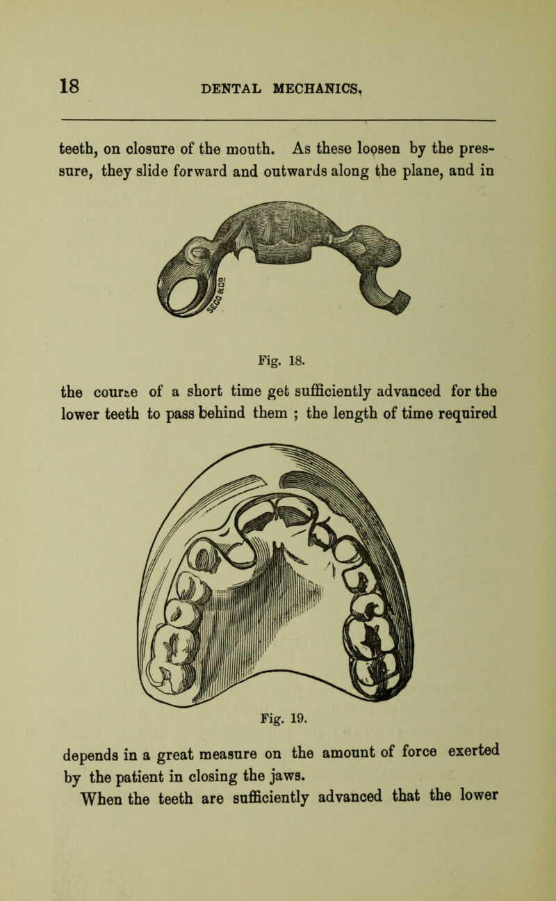 teeth, on closure of the mouth. As these loosen by the pres- sure, they slide forward and outwards along the plane, and in Fig. 18. the cour&e of a short time get sufficiently advanced for the lower teeth to pass behind them ; the length of time required depends in a great measure on the amount of force exerted by the patient in closing the jaws. When the teeth are sufficiently advanced that the lower