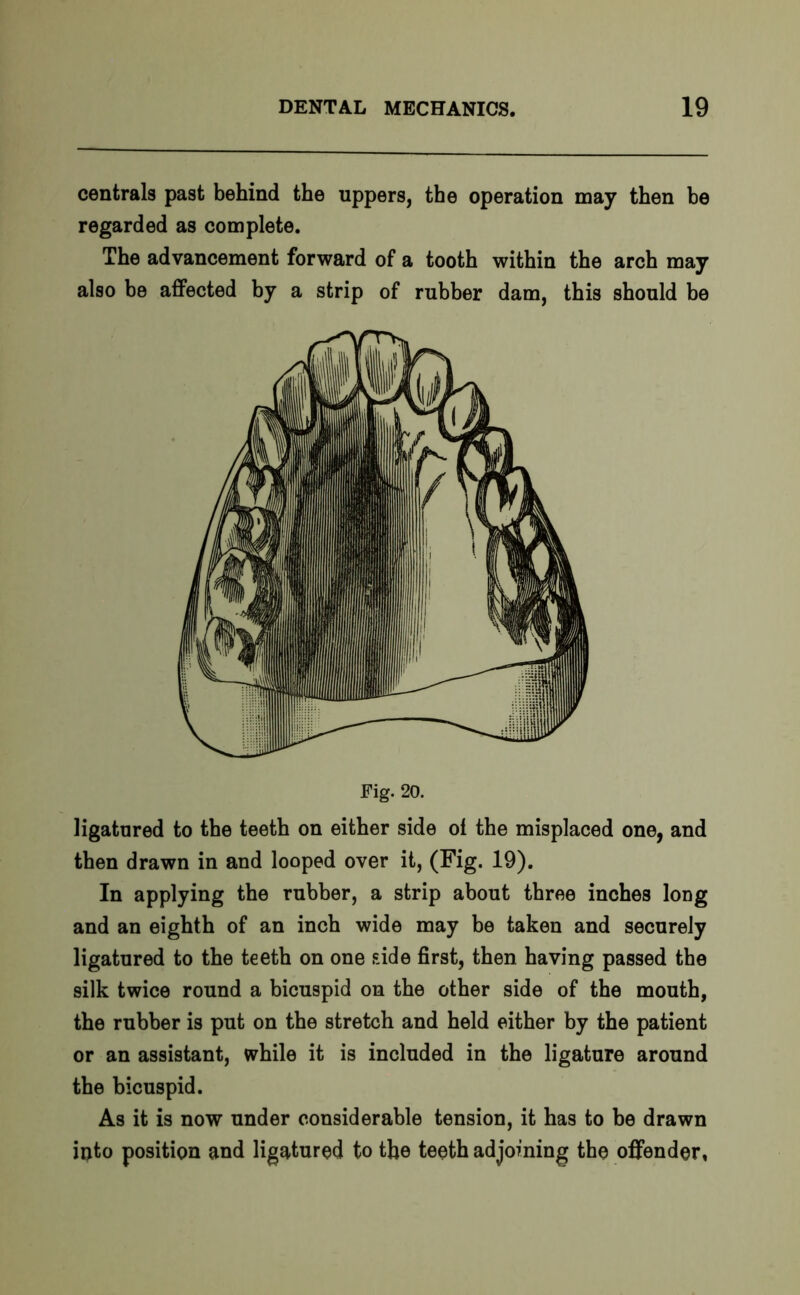 centrals past behind the uppers, the operation may then be regarded as complete. The advancement forward of a tooth within the arch may also be affected by a strip of rubber dam, this should be Fig. 20. ligatured to the teeth on either side ol the misplaced one, and then drawn in and looped over it, (Fig. 19). In applying the rubber, a strip about three inches long and an eighth of an inch wide may be taken and securely ligatured to the teeth on one side first, then having passed the silk twice round a bicuspid on the other side of the mouth, the rubber is put on the stretch and held either by the patient or an assistant, while it is included in the ligature around the bicuspid. As it is now under considerable tension, it has to be drawn into position and ligatured to the teeth adjoining the offender,