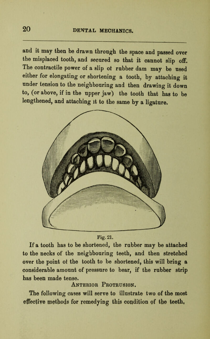 and it may then be drawn through the space and passed over the misplaced tooth, and secured so that it cannot slip off. The contractile power of a slip ot rubber dam may be used either for elongating or shortening a tooth, by attaching it under tension to the neighbouring and then drawing it down to, (or above, if in the upper jaw) the tooth that has to be lengthened, and attaching it to the same by a ligature. Fig. 21. If a tooth has to be shortened, the rubber may be attached to the necks of the neighbouring teeth, and then stretched over the point ot the tooth to be shortened, this will bring a considerable amount of pressure to bear, if the rubber strip has been made tense. Anterior Protrusion. The following cases will serve to illustrate two of the most effective methods for remedying this condition of the teeth,