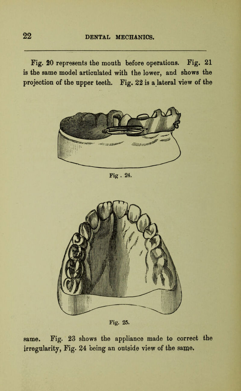 Fig. 20 represents the mouth before operations. Fig. 21 is the same model articulated with the lower, and shows the projection of the upper teeth. Fig. 22 is a lateral view of the Fig . 24. Fig. 25. same. Fig. 23 shows the appliance made to correct the irregularity, Fig. 24 being an outside view of the same.