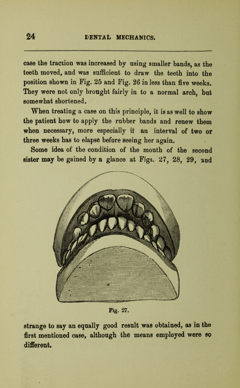 case the traction was increased by using smaller bands, as the teeth moved, and was sufficient to draw the teeth into the position shown in Fig. 25 and Fig. 26 in less than five weeks. They were not only brought fairly in to a normal arch, but somewhat shortened. When treating a case on this principle, it is as well to show the patient how to apply the rubber bands and renew them when necessary, more especially it an interval of two or three weeks has to elapse before seeing her again. Some idea of the condition of the mouth of the second sister may be gained by a glance at Figs. 27, 28, 29, and strange to say an equally good result was obtained, as in the first mentioned case, although the means employed were so different.