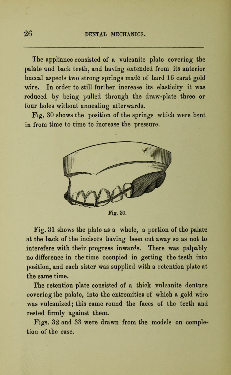 The appliance consisted of a vulcanite plate covering the palate and back teeth, and having extended from its anterior buccal aspects two strong springs made of hard 16 carat gold wire. In order to still further increase its elasticity it was reduced by being palled through the draw-plate three or four holes without annealing afterwards. Fig. 30 shows the position of the springs which were bent in from time to time to increase the pressure. Fig. 30. Fig. 31 shows the plate as a whole, a portion of the palate at the back of the incisors having been cut away so as not to interefere with their progress inwards. There was palpably no difference in the time occupied in getting the teeth into position, and each sister was supplied with a retention plate at the same time. The retention plate consisted of a thick vulcanite denture covering the palate, into the extremities of which a gold wire was vulcanized; this came round the faces of the teeth and rested firmly against them. Figs. 32 and 33 were drawn from the models on comple- tion of the case.
