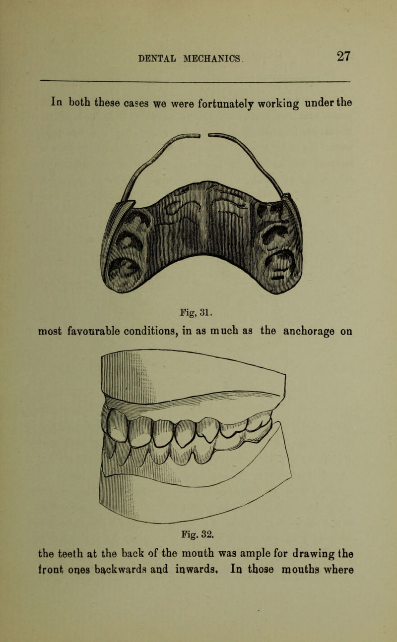 In both these cases we were fortunately working under the Fig, 31. most favourable conditions, in as much as the anchorage on Fig. 32. the teeth at the back of the mouth was ample for drawing the front ones backwards and inwards. In those mouths where
