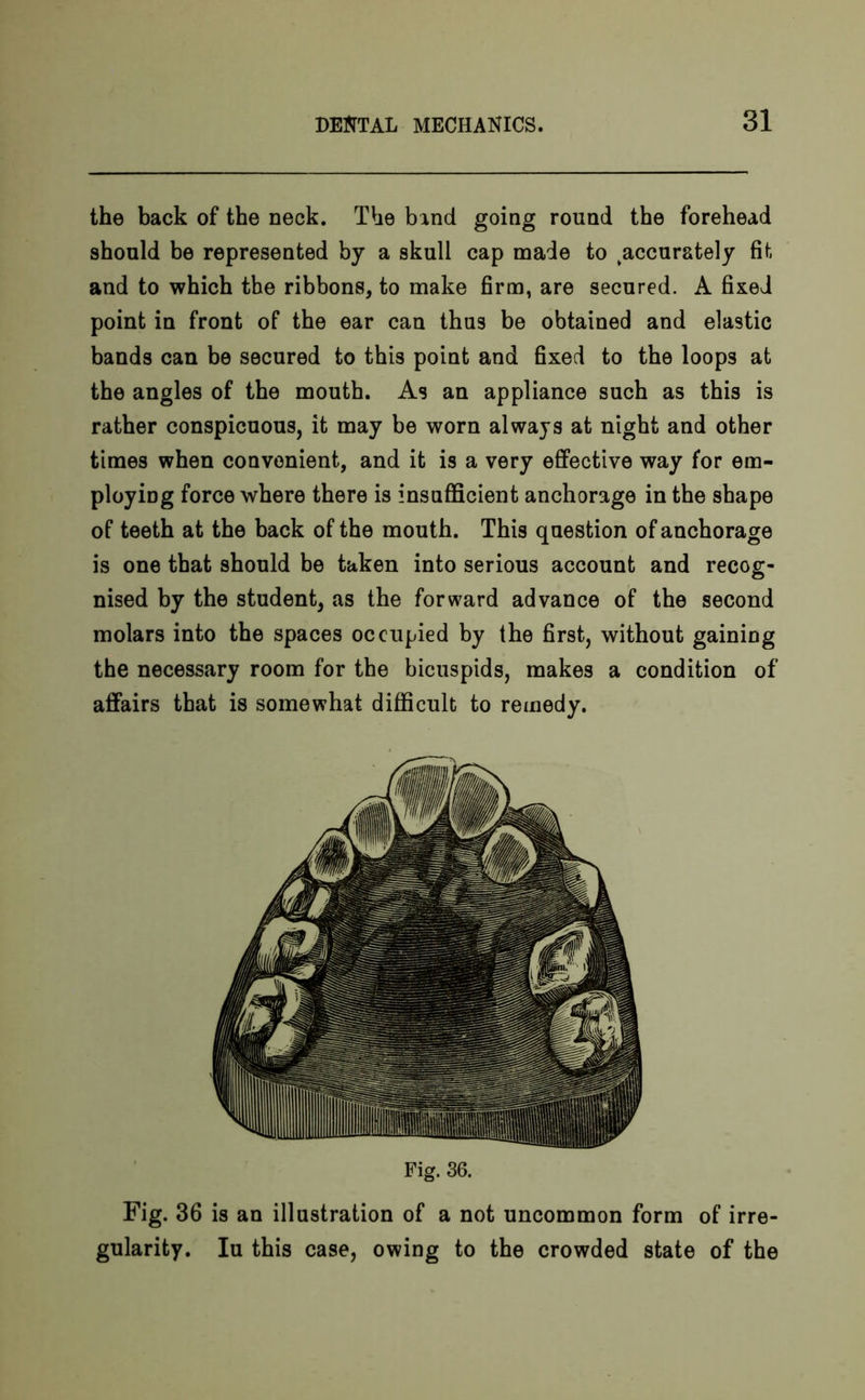 the back of the neck. The band going round the forehead should be represented by a skull cap made to ^accurately fit and to which the ribbons, to make firm, are secured. A fixed point in front of the ear can thus be obtained and elastic bands can be secured to this point and fixed to the loops at the angles of the mouth. As an appliance such as this is rather conspicuous, it may be worn always at night and other times when convenient, and it is a very effective way for em- ploying force where there is insufficient anchorage in the shape of teeth at the back of the mouth. This question of anchorage is one that should be taken into serious account and recog- nised by the student, as the forward advance of the second molars into the spaces occupied by the first, without gaining the necessary room for the bicuspids, makes a condition of affairs that is somewhat difficult to remedy. Fig. 36. Fig. 36 is an illustration of a not uncommon form of irre- gularity. Iu this case, owing to the crowded state of the