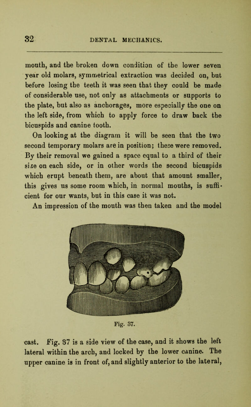 mouth, and the broken down condition of the lower seven year old molars, symmetrical extraction was decided on, but before losing the teeth it was seen that they could be made of considerable use, not only as attachments or supports to the plate, but also as anchorages, more especially the one on the left side, from which to apply force to draw back the bicuspids and canine tooth. On looking at the diagram it will be seen that the two second temporary molars are in position; these were removed. By their removal we gained a space equal to a third of their size on each side, or in other words the second bicuspids which erupt beneath them, are about that amount smaller, this gives us some room which, in normal mouths, is suffi- cient for our wants, but in this case it was not. An impression of the mouth was then taken and the model Fig. 37. cast. Fig. 87 is a side view of the case, and it shows the left lateral within the arch, and locked by the lower canine. The upper canine is in front of, and slightly anterior to the lateral,