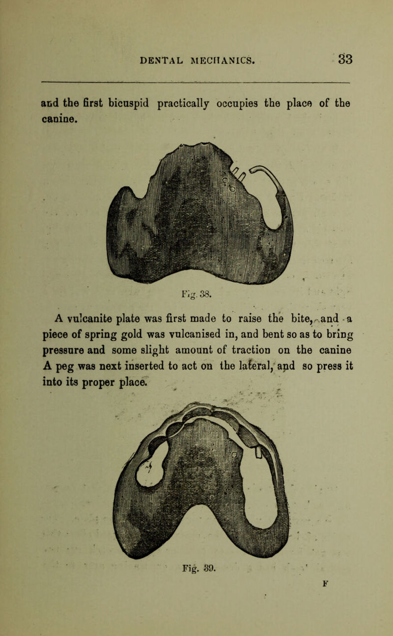 and the first bicuspid practically occupies the place of the canine. Fig. 38. A vulcanite plate was first made to raise the bite,- and a piece of spring gold was vulcanised in, and bent so as to bring pressure and some slight amount of traction on the canine A peg was next inserted to act on the lateral, and so press it into its proper place. Fig. 89. V