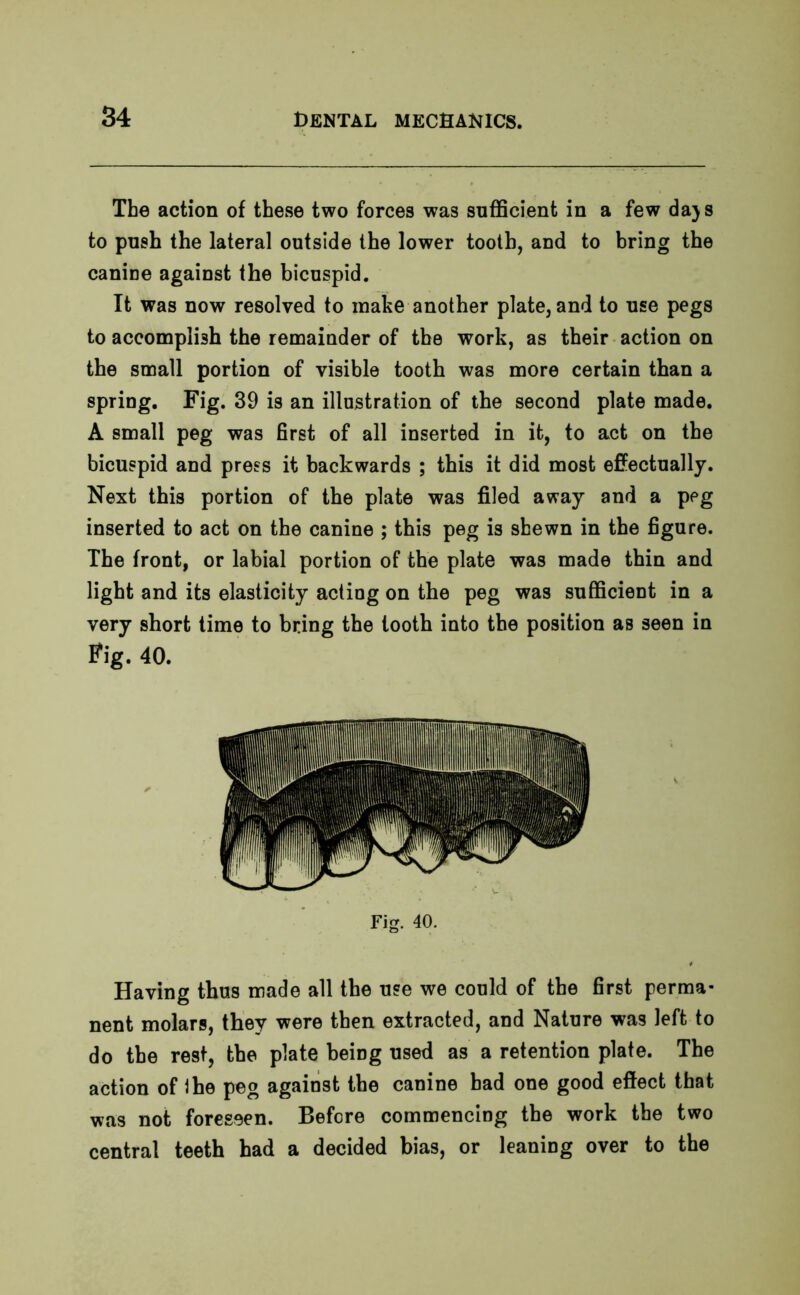 The action of these two forces was sufficient in a few da)s to push the lateral outside the lower tooth, and to bring the canine against the bicuspid. It was now resolved to make another plate, and to use pegs to accomplish the remainder of the work, as their action on the small portion of visible tooth was more certain than a spring. Fig. 39 is an illustration of the second plate made. A small peg was first of all inserted in it, to act on the bicuspid and press it backwards ; this it did most effectually. Next this portion of the plate was filed away and a peg inserted to act on the canine ; this peg is shewn in the figure. The front, or labial portion of the plate was made thin and light and its elasticity acting on the peg was sufficient in a very short time to bring the tooth into the position as seen in Fig. 40. Fig. 40. Having thus made all the use we could of the first perma- nent molars, they were then extracted, and Nature was left to do the rest, the plate being used as a retention plate. The action of the peg against the canine had one good effect that was not foreseen. Before commencing the work the two central teeth had a decided bias, or leaning over to the