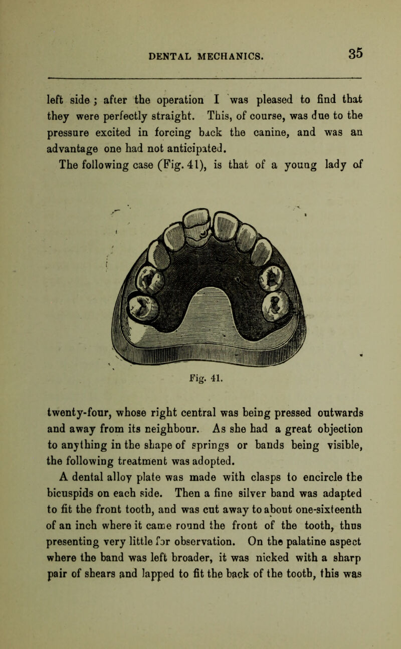 left side ; after the operation I was pleased to find that they were perfectly straight. This, of course, was due to the pressure excited in forcing back the canine, and was an advantage one had not anticipated. The following case (Fig. 41), is that of a young lady of Fig. 41. twenty-four, whose right central was being pressed outwards and away from its neighbour. As she had a great objection to anything in the shape of springs or bands being visible, the following treatment was adopted. A dental alloy plate was made with clasps to encircle the bicuspids on each side. Then a fine silver band was adapted to fit the front tooth, and was cut away to about one-sixteenth of an inch where it came round the front of the tooth, thus presenting very little for observation. On the palatine aspect where the band was left broader, it was nicked with a sharp pair of shears and lapped to fit the hack of the tooth, this was