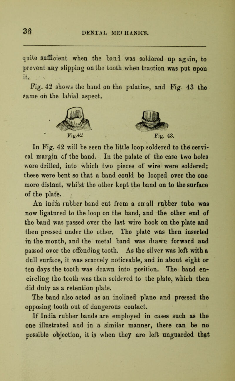 38 quite sufficient when the bani was soldered up agiin, to prevent any slipping on the tooth when traction was put upon it,; ; Fig. 42 shows the band on the palatine, and Fig. 43 the fame oh the labial aspect. Fig.42 Fig. 43. In Fig. 42 will be seen the little loop soldered to the cervi- cal margin cf the band. In the palate of the case two holes were drilled, into which two pieces of wire were soldered; these were bent so that a band could be looped over the one more distant, whilst the other kept the band on to the surface of the plate. An india rubber band cut from a sir all rubber tube was now ligatured to the loop on the band, and the other end of the band was passed oyer the last wire hook on the plate and then pressed under the other. The plate was then inserted in the month, and the metal band was drawn forward and passed over the offending tooth. As the silver was left with a dull surface, it was scarcely noticeable, and in about eight or ten days the tooth was drawn into position. The band en- circling the teeth was then soldered to the plate, which then did duty as a retention plate. The band also acted as an inclined plane and pressed the opposing tooth out of dangerous contact. If India rubber bands are employed in cases such as the one illustrated and in a similar manner, there can be no possible objection, it is when they are left unguarded that