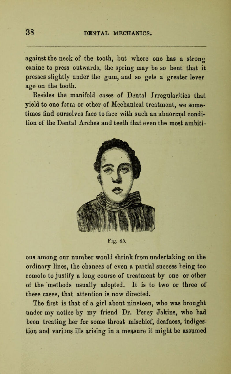 against the neck of the tooth, but where one has a strong canine to press outwards, the spring may be so bent that it presses slightly under the gum, and so gets a greater lever age on the tooth. Besides the manifold cases of Dental Irregularities that yield to one form or other of Mechanical treatment, we some- times find ourselves face to face with such an abnormal condi- tion of the Dental Arches and teeth that even the most ambiti- Fig. 45. ous among our number would shrink from undertaking on the ordinary lines, the chances of even a partial success being too remote to justify a long course of treatment by one or other ot the methods usually adopted. It is to two or three of these cases, that attention is now directed. The first is that of a girl about nineteen, who was brought under my notice by my friend Dr. Percy Jakins, who had been treating her for some throat mischief, deafness, indiges- tion and various ills arising in a measure it might be assumed