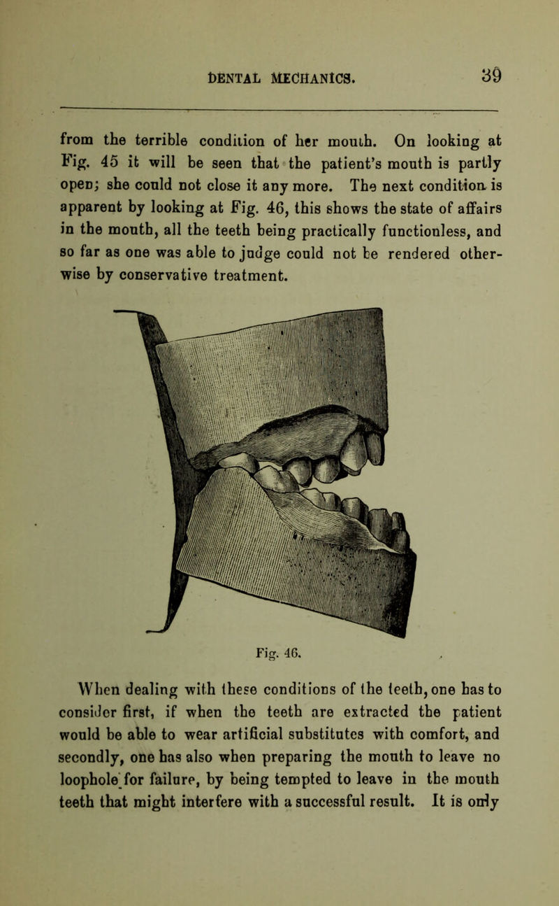 from the terrible condition of her mouih. On looking at Fig. 45 it will be seen that the patient’s mouth is partly open; she could not close it any more. The next condition, is apparent by looking at Fig. 46, this shows the state of affairs in the mouth, all the teeth being practically functionless, and so far as one was able to judge could not be rendered other- wise by conservative treatment. Fig. 46. When dealing with these conditions of the teeth, one has to consider first, if when the teeth are extracted the patient would be able to wear artificial substitutes with comfort, and secondly, one has also when preparing the mouth to leave no loophole for failure, by being tempted to leave in the mouth teeth that might interfere with a successful result. It is oriy