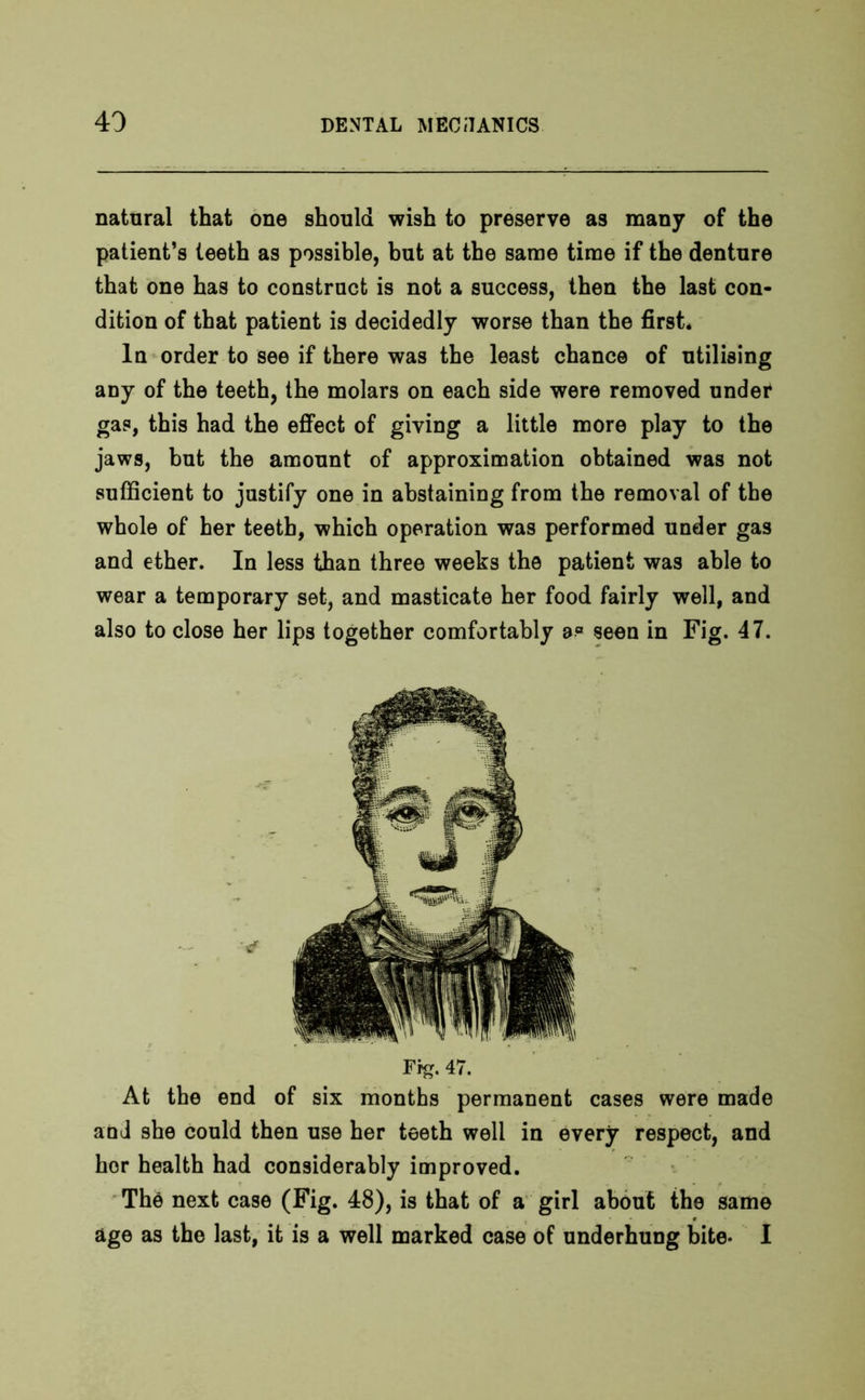 natural that one should wish to preserve as many of the patient’s teeth as possible, but at the same time if the denture that one has to construct is not a success, then the last con- dition of that patient is decidedly worse than the first. In order to see if there was the least chance of utilising any of the teeth, the molars on each side were removed under gas, this had the effect of giving a little more play to the jaws, but the amount of approximation obtained was not sufficient to justify one in abstaining from the removal of the whole of her teeth, which operation was performed under gas and ether. In less than three weeks the patient was able to wear a temporary set, and masticate her food fairly well, and also to close her lips together comfortably a° seen in Fig. 47. Fi^. 47. At the end of six months permanent cases were made and she could then use her teeth well in every respect, and her health had considerably improved. The next case (Fig. 48), is that of a girl about the same age as the last, it is a well marked case of underhung bite- I