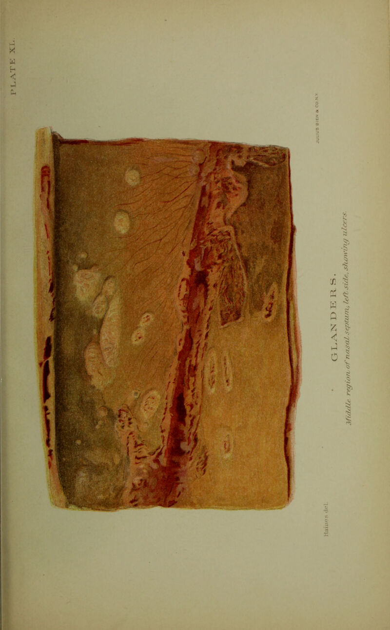 PLATE XL. GLAN DERS. Mid/lie regions of nxisaLseptunv, left side, showing ulcers.