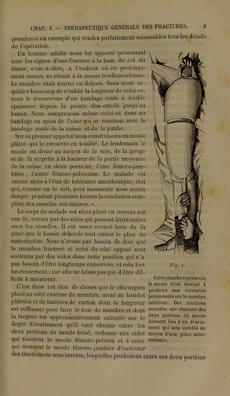 prendrons un exemple qui rendra parfaitement saisissables tous les détails de l’opération. Un homme adulte nous fut apporté présentant tous les signes d’une fracture à la base du col du fémur, c’est-à-dire, à l’endroit où ce prolonge- ment osseux se réunit à la masse trochantérienne. Le membre était tourné en dehors. Sans nous in- quiéter beaucoup de rétablir la longueur de celui-ci, nous le recouvrons d’un bandage roulé à double épaisseur depuis la pointe des» orteils jusqu’au bassin. Nous comprenons même celui-ci dans un bandage en spica de l’aine qui se continue avec le bandage roulé de la cuisse et de la jambe. Sur ce premier appareil nous construisons un moule plâtré qui le recouvre en totalité. Le lendemain le moule est divisé au moyen de la scie, de la gouge et de la serpette à la hauteur de la partie moyenne de la cuisse en deux portions, l’une fémoro-jam- bière, l’autre fémoro-pelvienne. Le malade est amené alors à l’état de tolérance anesthésique, état qui, comme on le sait, peut maintenir sans aucun danger pendant plusieurs heures la résolution com- plète des muscles volontaires. - Le corps du malade est alors placé en travers sur son lit, retenu par des aides qui passent leurs mains sous les aisselles. Il est assez avancé hors du lit pour que le bassin déborde tout entier le plan de sustentation. Nous n’avons pas besoin de dire que le membre fracturé et celui du côté opposé sont soutenus par des aides dans cette position qui n’a pas besoin d’être longtemps conservée, et cela fort heureusement ; car elle ne laisse pas que d’être dif- ficile à maintenir. C’est dans cet état de choses que le chirurgien placé au côté externe du membre, muni de bandes plâtrées et de lanières de carton dont la longueur est suffisante pour faire le tour du membre et dont exercées sur chacune des la largeur est approximativement calculée sur le deux poltlons du mouIe degré d écartement qu’il veut obtenir entre les deux portions du moule brisé, ordonne aux aides qui tiennent le moule fémoro-pelvicn et à ceux qui tiennent le moule fémoro-jambier d’exécuter des tractions en sens inverse, lesquelles produisent entre ces deux portions Ficj. i. Cette planche représente le moule brisé destiné à produire une extension permanente sur le membre inférieur. Des tractions donnent lieu à un écarte- ment qui sera comblé au moyen d’une pièce inter- médiaire.