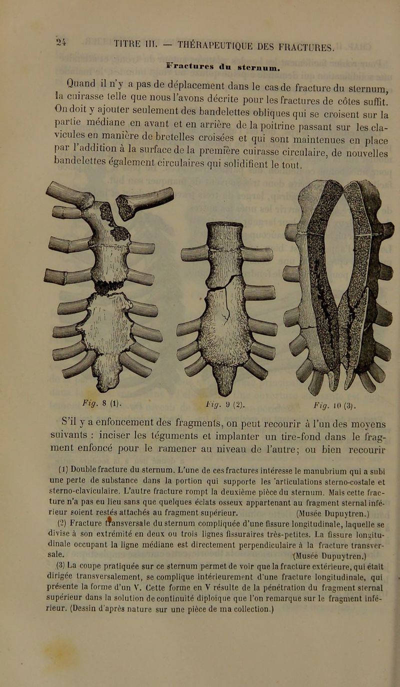 l'ractures «lu sternum. Quand il n ) a pas de déplacement dans le cas de fracture du sternum, la cuirasse telle que nous l’avons décrite pour les fractures de côtes suffit. On doit \ ajouter seulement des bandelettes obliques qui se croisent sur la parlie médiane en avant et en arrière de la poitrine passant sur les cla- vicules en manière de bretelles croisées et qui sont maintenues en place par l’addition à la surface de la première cuirasse circulaire, de nouvelles bandeletles également circulaires qui solidifient le tout. Fi9- « (D- fig. 9(2). Fig. U)(3). S il y a enfoncement des fragments, on peut recourir à l’undes moyens suivants : inciser les téguments et implanter un lire-fond dans le frag- ment enfoncé pour le ramener au niveau de l’autre; ou bien recourir (1) Double fracture du sternum. L’une de cesfractures intéresse le manubrium qui a subi une perte de substance dans la portion qui supporte les ‘articulations sterno-costale et slerno-claviculaire. L’autre fracture rompt la deuxième pièce du sternum. Mais cette frac- ture n’a pas eu lieu sans que quelques éclats osseux appartenant au fragment sternal infé- rieur soient restés attachés au fragment supérieur. (Musée Dupuytren.) (2) Fracture tfansversale du sternum compliquée d’une tissure longitudinale, laquelle se divise à son extrémité en deux ou trois lignes fissuraires très-petites. La tissure longitu- dinale occupant la ligne médiane est directement perpendiculaire la fracture transver- sale- (Musée Dupuytren.) (3) La coupe pratiquée sur ce sternum permet de voir que la fracture extérieure, qui était dirigée transversalement, se complique intérieurement d'une fracture longitudinale, qui présente la forme d’un V. Cette forme en V résulte de la pénétration du fragment sternal supérieur dans la solution de continuité diploïque que l’on remarque sur le fragment infé- rieur. (Dessin d'après nature sur une pièce de ma collection.)