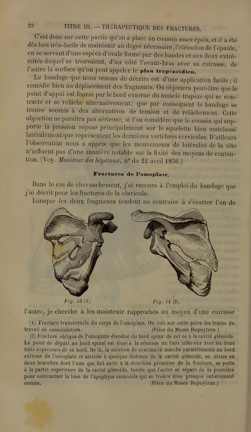 C est donc sur cette partie qu on a placé un coussin assez épais, et il a été dès lors très-facile de maintenir au degré nécessaire, l’élévation de l’épaule en se servant d’une espèce d’ovale formé par des bandes et aux deux extré- mités duquel se Couvaient, d un côté l’avant-bras avec sa cuirasse, de 1 autre la surface qu on peut appeler le plan trapézoïdien. Le bandage que nous venons de décrire est d’une application facile ; il îemédie bien au déplacement des fragments. On objectera peut-être que le point d’appui est fourni par le bord externe du muscle trapèze qui se con- tracte et se relâche alternativement; que par conséquent le bandage se trouve soumis à des alternatives de tension et de relâchement. Cette objection ne paraîtra pas sérieuse, si l’on considère que le coussin qui sup- porte la pression repose principalement sur le squelette bien matelassé latéralement que représentent les dernières vertèbres cervicales. D’ailleurs 1 observation nous a appris que les mouvements de latéralité de la tête n’influent pas d’une manière notable sur la fixité des moyens de conten- tion. (Voy. Moniteur des hôpitaux, n° du 22 avril 1836.) Fractures de l’omoplate. Dans le cas de chevauchement, j’ai recours à l’emploi du bandage que j’ai décrit pour les fractures de la clavicule. Lorsque les deux fragments tendent au contraire à s’écarter l’un de Fig. 13 (1). Fig. U (2). l’autre, je cherche à les maintenir rapprochés au moyen d’une cuirasse (1) Fracture transversale du corps de l’omoplate. On voit sur celte pièce les traces du travail de consolidation. (Pièce du Musée Dupuytren ) (2) Fracture oblique de l’omoplate étendue du bord spinal de cet os à la cavité glénoïde. Le point de départ au bord spinal est situé à la réunion du tiers inférieur avec les deux tiers supérieurs de ce bord. De là, la solution de continuité marche parallèlement au bord externe de l’omoplate et arrivée à quelque distance de la cavité glénoïde, se divise en deux branches dont l’une qui fait suite à la direction primitive de la fracture, se porte à la partie supérieure de la cavité glénoïde, tandis que l’autre se sépare de la première pour contourner la base de l’apophyse coracoïde qui se trouve ainsi presque entièrement cernée. {Pièce du Musée Dupuytren )