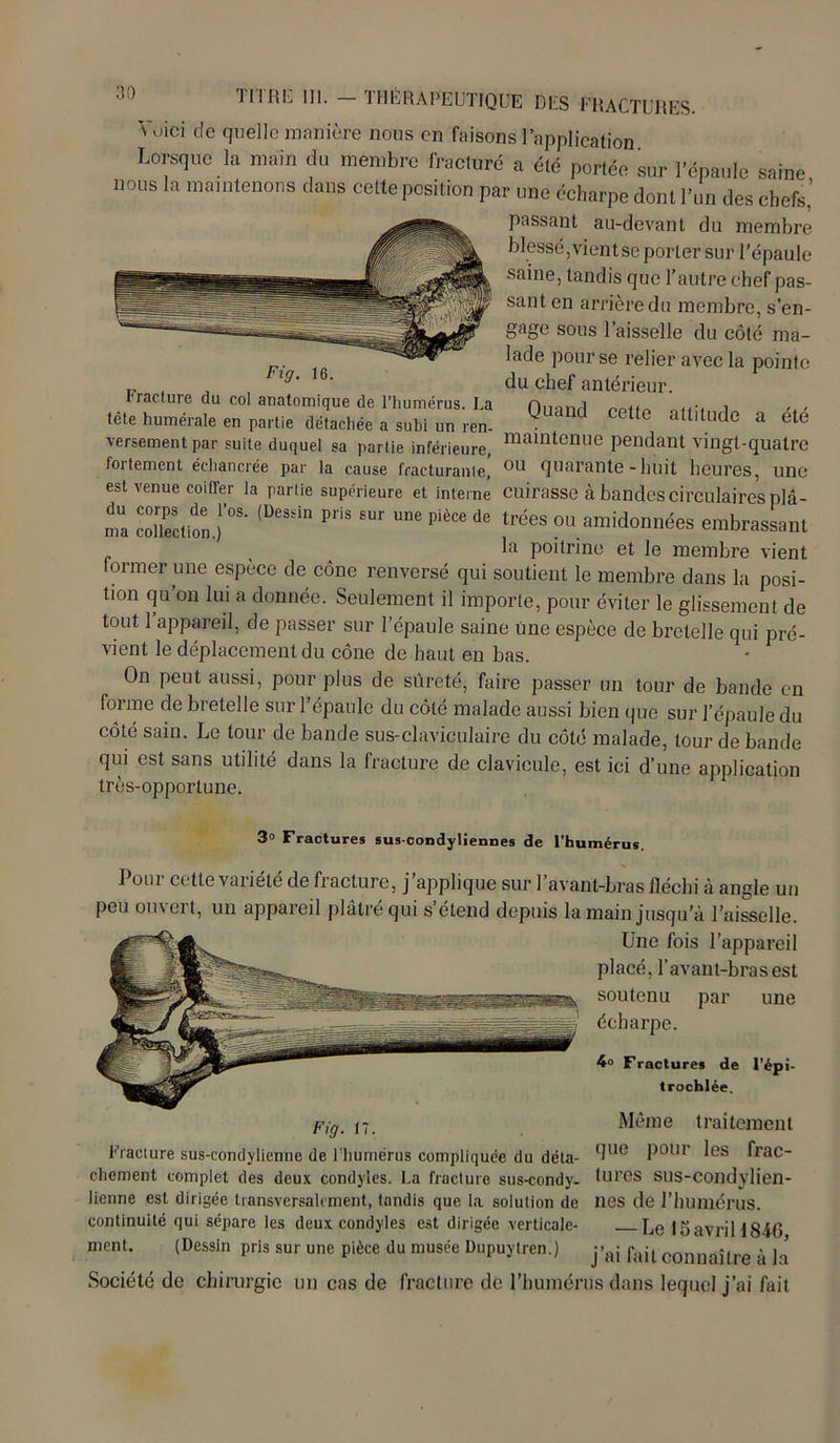 Voici de quelle manière nous en faisons l’application Lorsque la main du membre fracturé a été portée sur l'épaule saine nous la maintenons clans cette position par une écharpe dont l'un des chefs, passant au-devant du membre blessé,vientseporter sur l’épaule saine, tandis que l’autre chef pas- sant en arrière du membre, s’en- gage sous l’aisselle du côté ma- lade pour se relier avec la pointe „ , , 19‘ 6‘ du chef antérieur. Fracture du col anatomique de l’humérus. La Duanrl mftn aii'i i ,,, tête humérale en partie détachée a subi un ren- T d U altllU(le a ete versement par suite duquel sa partie inférieure, maintenue pendant vingt-quatre fortement échancrée par la cause fracturanle, ou Quarante - huit heures, une est venue coiffer la partie supérieure et interne cuirasse à bandes circulaires plâ- ma collection.)'08 (D'S‘ln P'IS ’“r pièce de «es ou amidonnées embrassant ba poitrine et le membre vient former une espèce de cône renversé qui soutient le membre dans la posi- tion qu’on lui a donnée. Seulement il importe, pour éviter le glissement de tout l’appareil, de passer sur l’épaule saine une espèce de bretelle qui pré- vient le déplacement du cône de haut en bas. On peut aussi, pour plus de sûreté, faire passer lui tour de bande en forme de bretelle sur l’épaule du côté malade aussi bien que sur l’épaule du côté sain. Le tour de bande sus-claviculaire du côté malade, tour de bande qui est sans utilité dans la fracture de clavicule, est ici d’une application très-opportune. 3° Fractures sus-condyliennes de l’humérus. 1 oui cette variété de fracture, j applique sur l’avant-bras fléchi à angle un peu ouvert, un appareil plâtré qui s’étend depuis la main jusqu’à l’aisselle. Une fois l’appareil placé, l’avant-bras est soutenu par une écharpe. 4° Fractures de l’épi- trochlée. Même traitement Fracture sus-condylienne de l’humérus compliquée du déta- 9ue Pour ^es frac- chement complet des deux condyles. La fracture sus-condy- turôs sus-condylien- Jienne est dirigée transversalement, tandis que la solution de lies de l'humérus. continuité qui sépare les deux condyles est dirigée verticale- Le 15 avril 1846 ment. (Dessin pris sur une pièce du musée Dupuytren.) j’ai fait connaître à la Société de chirurgie un cas de fracture de l’humérus dans lequel j’ai fait