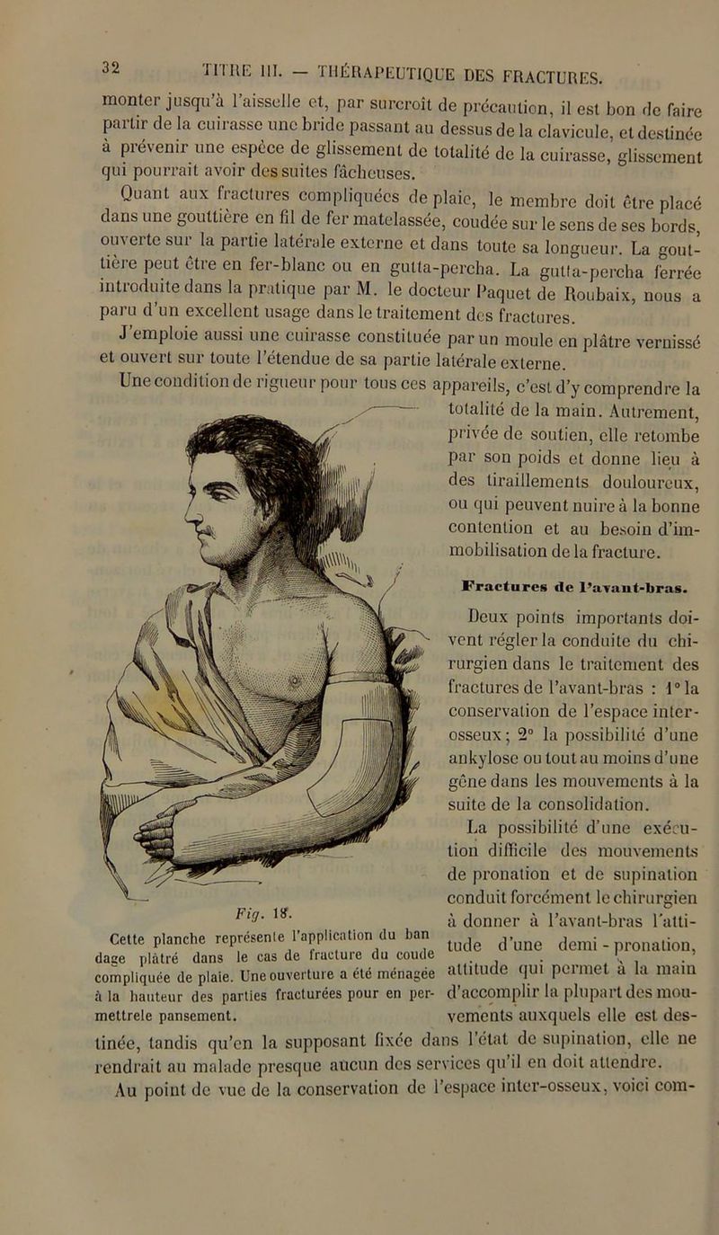 monter jusqu a 1 aisselle et, par surcroît de précaution, il est bon de faire partir de la cuirasse une bride passant au dessus de la clavicule, et destinée à prévenir une espèce de glissement de totalité de la cuirasse, glissement qui pourrait avoir des suites fâcheuses. Quant aux fractures compliquées de plaie, le membre doit être placé dans une gouttière en fil de fer matelassée, coudée sur le sens de ses bords, ouverte sur la partie latérale externe et dans toute sa longueur. La gout- tière peut être en fer-blanc ou en gutta-percha. La gutfa-percha ferrée introduite dans la pratique par M. le docteur Paquet de Roubaix, nous a paru d’un excellent usage dans le traitement des fractures. J’emploie aussi une cuirasse constituée par un moule en plâtre vernissé et ouvert sur toute l’étendue de sa partie latérale externe. Une condition de rigueur pour tous ces appareils, c’est d’y comprendre la totalité de la main. Autrement, privée de soutien, elle retombe par son poids et donne lieu à des tiraillements douloureux, ou qui peuvent nuire à la bonne contention et au besoin d’im- mobilisation de la fracture. Fractures de l’avant-bras. Deux points importants doi- vent régler la conduite du chi- rurgien dans le traitement des fractures de l’avant-bras : l°la conservation de l’espace inter- osseux; 2° la possibilité d’une ankylosé ou tout au moins d’une gêne dans les mouvements à la suite de la consolidation. La possibilité d’une exécu- tion difficile des mouvements de pronation et de supination conduit forcément le chirurgien à donner à l’avant-bras l’atti- tude d’une demi - pronation, attitude qui permet à la main à la hauteur d*es parties fracturées pour en per- d’accomplir la plupart des mou- mettrele pansement. vements auxquels elle est des- tinée, tandis qu’en la supposant fixée dans l’état de supination, clic ne rendrait au malade presque aucun des services qu’il en doit attendre. Au point de vue de la conservation de l’espace inter-osseux, voici com- Fig. ts. Cette planche représente l’application du ban dage plâtré dans le cas de fracture du coude compliquée de plaie. Une ouverture a été ménagée