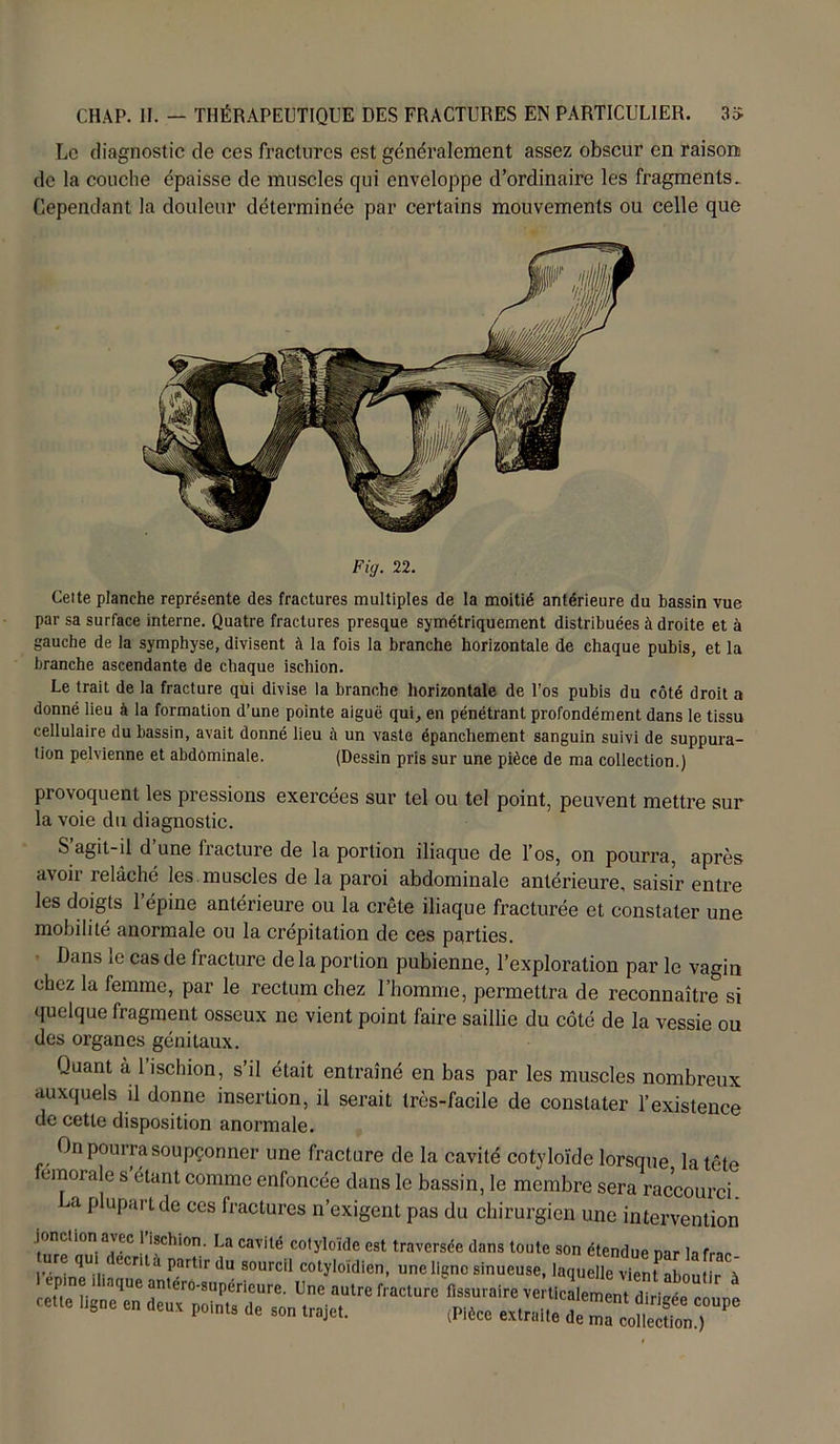 Le diagnostic de ces fractures est généralement assez obscur en raison de la couche épaisse de muscles qui enveloppe d’ordinaire les fragments. Cependant la douleur déterminée par certains mouvements ou celle que Fig. 22. Celte planche représente des fractures multiples de la moitié antérieure du bassin vue par sa surface interne. Quatre fractures presque symétriquement distribuées à droite et à gauche de la symphyse, divisent à la fois la branche horizontale de chaque pubis, et la branche ascendante de chaque ischion. Le trait de la fracture qui divise la branche horizontale de l’os pubis du côté droit a donné lieu à la formation d’une pointe aiguë qui, en pénétrant profondément dans le tissu cellulaire du bassin, avait donné lieu à un vaste épanchement sanguin suivi de suppura- tion pelvienne et abdominale. (Dessin pris sur une pièce de ma collection.) provoquent les pressions exercées sur tel ou tel point, peuvent mettre sur la voie du diagnostic. S agit-il d une fracture de la portion iliaque de l’os, on pourra, après avoir relâché les. muscles de la paroi abdominale antérieure, saisir entre les doigts l’épine antérieure ou la crête iliaque fracturée et constater une mobilité anormale ou la crépitation de ces parties. Dans le cas de fracture de la portion pubienne, l’exploration par le vagin chez la femme, par le rectum chez l’homme, permettra de reconnaître si quelque fragment osseux ne vient point faire saillie du côté de la vessie ou des oi’ganes génitaux. Quant à l’ischion, s’il était entraîné en bas par les muscles nombreux auxquels il donne insertion, il serait très-facile de constater l’existence de cette disposition anormale. On pourra soupçonner une fracture de la cavité cotyloïde lorsque la tête fémorale s’étant comme enfoncée dans le bassin, le membre sera raccourci, -a plupart de ces fractures n’exigent pas du chirurgien une intervention