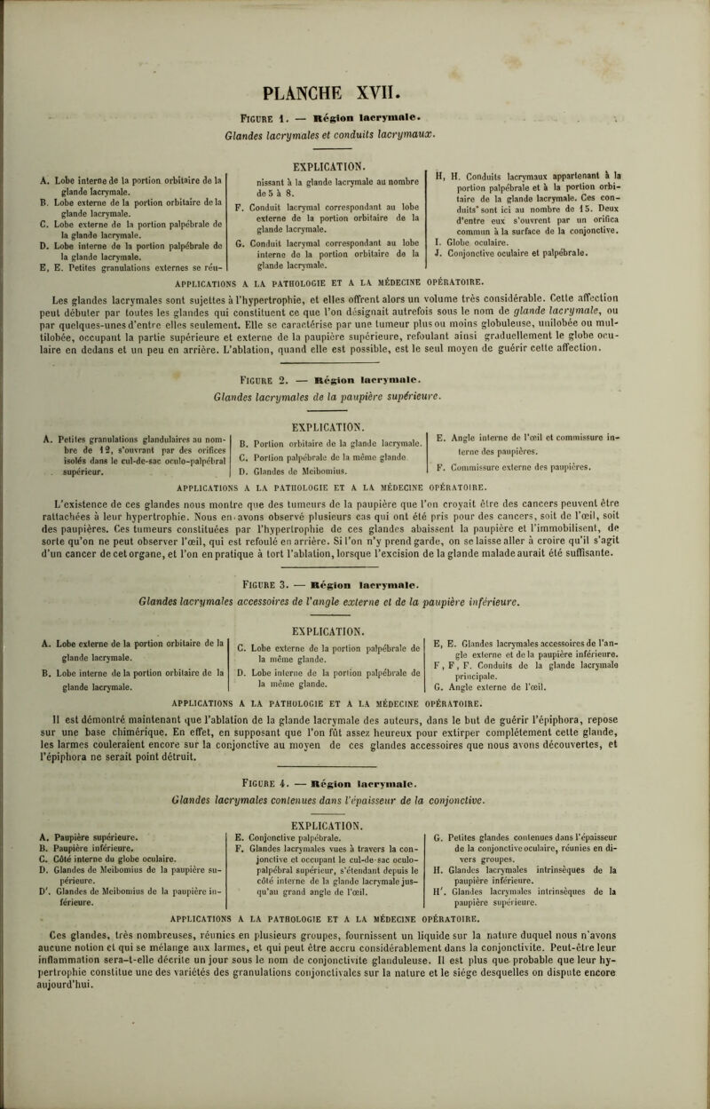Figure 1. — Région lacrymale. Glandes lacrymales et conduits lacrymaux. A. Lobe interne de la portion orbitaire de la glande lacrymale. B. Lobe externe de la glande lacrymale. C. Lobe externe de la portion palpébrale de la glande lacrymale. D. Lobe interne de la portion palpébrale de la glande lacrymale. E. E. Petites granulations externes se réu- EXPLICATION. nissant à la glande lacrymale au nombre de 5 à 8. F. Conduit lacrymal correspondant au lobe externe de la portion orbitaire de la glande lacrymale. G. Conduit lacrymal correspondant au lobe interne de la portion orbitaire do la glande lacrymale. H. H. Conduits lacrymaux appartenant à la portion palpébrale et à la portion orbi- taire de la glande lacrymale. Ces con- duits” sont ici au nombre de 15. Deux d'entre eux s’ouvrent par un orifica commun à la surface de la conjonctive. I. Globe oculaire. J. Conjonctive oculaire et palpébrale. OPÉRATOIRE. APPLICATIONS A LA PATHOLOGIE ET A LA MÉDECINE portion orbitaire delà Les glandes lacrymales sont sujettes à l’hypertrophie, et elles offrent alors un volume très considérable. Cette affection peut débuter par toutes les glandes qui constituent ce que l’on désignait autrefois sous le nom de glande lacrymale, ou par quelques-unes d’entre elles seulement. Elle se caractérise par une tumeur plus ou moins globuleuse, unilobée ou mul- tilobée, occupant la partie supérieure et externe de la paupière supérieure, refoulant ainsi graduellement le globe ocu- laire en dedans et un peu en arrière. L’ablation, quand elle est possible, est le seul moyen de guérir cette affection. FIGURE 2. — Région lacrymale. Glandes lacrymales de la paupière supérieure. A. Petites granulations glandulaires au nom- bre de 12, s’ouvranl par des orifices isolés dans le cul-dc-sac oculo-palpcbral supérieur. EXPLICATION. B. Portion orbitaire de la glande lacrymale. C. Portion palpébrale de la même glande D. Glandes de Meibomius. E. Angle interne de l’œil et commissure in- terne des paupières. F. Commissure externe des paupières. APPLICATIONS A LA PATHOLOGIE ET A LA MÉDECINE OPÉRATOIRE. L’existence de ces glandes nous montre que des tumeurs de la paupière que l’on croyait cire des cancers peuvent être rattachées à leur hypertrophie. Nous en-avons observé plusieurs cas qui ont été pris pour des cancers, soit de l’œil, soit des paupières. Ces tumeurs constituées par l'hypertrophie de ces glandes abaissent la paupière et l’immobilisent, de sorte qu’on ne peut observer l’œil, qui est refoulé en arrière. Si l’on n’y prend garde, on se laisse aller à croire qu’il s’agit d’un cancer de cet organe, et l’on en pratique à tort l’ablation, lorsque l’excision de la glande malade aurait été suffisante. Figure 3. — Région lacrymale. Glandes lacrymales accessoires de l'angle externe et de la paupière inférieure. A. Lobe externe de la portion orbitaire de la glande lacrymale. B. Lobe interne de la portion orbitaire de la glande lacrymale. EXPLICATION. C. Lobe externe do la portion palpébrale de la même glande. D. Lobe interne de la porlion palpébrale de la même glande. E, E. Glandes lacrymales accessoires de l'an- gle externe et de la paupière inférieure. F, F, F. Conduits de la glande lacrymale principale. G, Angle externe de l’œil. APPLICATIONS A LA PATHOLOGIE ET A LA MÉDECINE OPÉRATOIRE. 11 est démontré maintenant que l’ablation de la glande lacrymale des auteurs, dans le but de guérir l’épiphora, repose sur une base chimérique. En effet, en supposant que l’on fût assez heureux pour extirper complètement cette glande, les larmes couleraient encore sur la conjonctive au moyen de ces glandes accessoires que nous avons découvertes, et l’épiphora ne serait point détruit. FIGURE 4. — Région lacrymale. Glandes lacrymales contenues dans l’épaisseur de la conjonctive. A. Paupière supérieure. B. Paupière inférieure. C. Côté interne du globe oculaire. D. Glandes de Meibomius de la paupière su- périeure. D'. Glandes de Meibomius de la paupière in- férieure. EXPLICATION. E. Conjonctive palpébrale. F. Glandes lacrymales vues à travers la con- jonctive et occupant le cul-de-sac oculo- palpébral supérieur, s’étendant depuis le côté interne de la glande lacrymale jus- qu’au grand angle de l’œil. G. Petites glandes contenues dans l’épaisseur de la conjonctive oculaire, réunies en di- vers groupes. H. Glandes lacrymales intrinsèques de la paupière inférieure. H'. Glandes lacrymales intrinsèques de la paupière supérieure. OPÉRATOIRE. APPLICATIONS A LA PATHOLOGIE ET A LA MÉDECINE Ces glandes, très nombreuses, réunies en plusieurs groupes, fournissent un liquide sur la nature duquel nous n’avons aucune notion et qui se mélange aux larmes, et qui peut être accru considérablement dans la conjonctivite. Peut-être leur inflammation sera-t-elle décrite un jour sous le nom de conjonctivite glanduleuse. 11 est plus que probable que leur hy- pertrophie constitue une des variétés des granulations conjonctivales sur la nature et le siège desquelles on dispute encore aujourd’hui.