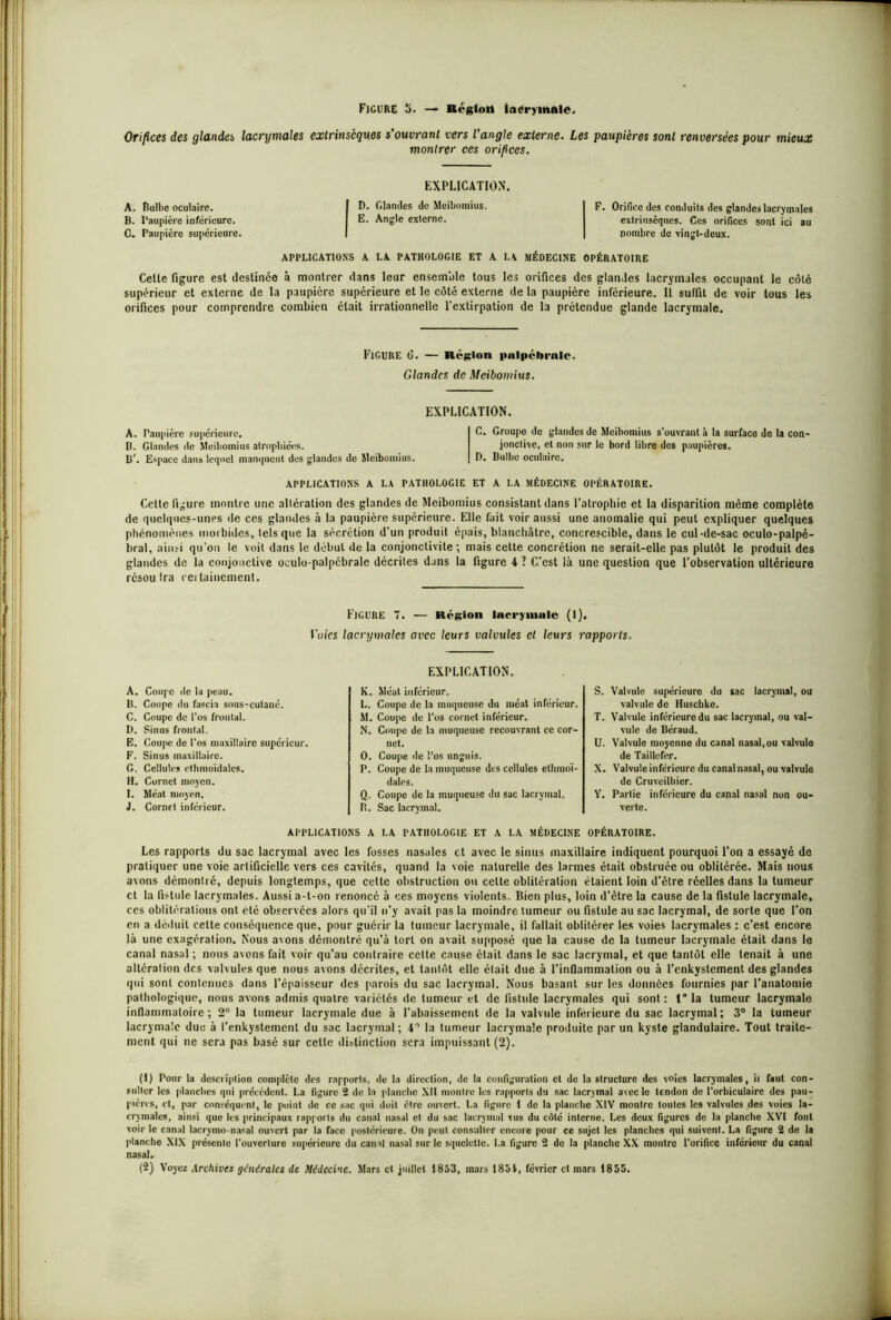 Orifices des glandes lacrymales extrinsèques s'ouvrant vers l’angle externe. Les paupières sont renversées pour mieux montrer ces orifices. EXPLICATION. A. Bulbe oculaire. I D- Glandes de Meibomius. B. Paupière inférieure. I E. Angle exlcrne. C. Paupière supérieure. APPLICATIONS A LA PATHOLOGIE ET A LA MÉDECINE OPÉRATOIRE Celle figure est deslinéo à montrer dans leur ensemble tous les orifices des glandes lacrymales occupant le côté supérieur et externe de la paupière supérieure et le côté externe de la paupière inférieure. Il suffit de voir tous les orifices pour comprendre combien était irrationnelle l’extirpation de la prétendue glande lacrymale. F. Orifice des conduits des glandes lacrymales extrinsèques. Ces orifices sont ici au nombre de vingt-deux. FIGURE 6. — Région palpébrale. Glandes de Meibomius. EXPLICATION. A. Paupière supérieure. B. Glandes de Meibomius atrophiées. B’. Espace dans lequel manquent des glandes de Meibomius. APPLICATIONS A LA PATHOLOGIE C. Groupe de glandes de Meibomius s’ouvrant à la surface de la con- jonctive, cl non sur le bord libre des paupières. D. Bulbe oculaire. ET A LA MÉDECINE OPÉRATOIRE. Cette figure montre une altération des glandes de Meibomius consistant dans l’atrophie et la disparition même complète de quelques-unes de ces glandes à la paupière supérieure. Elle fait voir aussi une anomalie qui peut expliquer quelques phénomènes morbides, tels que la sécrétion d’un produit épais, blanchâtre, concrescible, dans le cul-de-sac oculo-palpé- bral, ainsi qu'on le voit dans le début de la conjonctivite; mais celte concrétion ne serait-elle pas plutôt le produit des glandes de la conjonctive oculo-palpcbralc décrites dans la figure 4 ? C’est là une question que l’observation ultérieure résou Ira cet laidement. FIGURE 7. — Région laci-ymulc (I). fuies lacrymales avec leurs valvules cl leurs rapports. A. Coupe de la peau. B. Coupe du fascia sous-cutané. C. Coupe de l’os frontal. D. Sinus frontal. E. Coupe de l'os maxillaire supérieur. F. Sinus maxillaire. G. Cellules cthmoïdalcs. H. Cornet moyen. I. Méat moyen. J. Cornet inférieur. EXPLICATION. K. Méat inférieur. L. Coupe de la muqueuse du méat inférieur. M. Coupe de l'os cornet inférieur. N. Coupe de la muqueuse recouvrant ce cor- net. O. Coupe de l’os unguis. P. Coupe de la muqueuse des cellules etlimoï- dales. Q. Coupe de la muqueuse du sac lacrymal. B. Sac lacrymal. S. Valvule supérieure du sac lacrymal, ou valvule de Huscbko. T. Valvule inférieure du sac lacrymal, ou val- vule de Béraud. U. Valvule moyenne du canal nasal,ou valvulo de Taillefcr. X. Valvule inférieure du canal nasal, ou valvule de Cruvcilliier. Y. Partie inférieure du canal nasal non ou- verte. OPÉRATOIRE. APPLICATIONS A LA PATHOLOGIE ET A LA MÉDECINE Les rapports du sac lacrymal avec les fosses nasales et avec le sinus maxillaire indiquent pourquoi l'on a essayé de pratiquer une voie artificielle vers ces cavités, quand la voie naturelle des larmes était obstruée ou oblitérée. Mais nous avons démontré, depuis longtemps, que celte obstruction ou cette oblitération étaient loin d’être réelles dans la tumeur et la fistule, lacrymales. Aussi a-t-on renoncé à ces moyens violents. Bien plus, loin d'être la cause de la fistule lacrymale, ces oblitérations ont été observées alors qu'il n’y avait pas la moindre tumeur ou fistule au sac lacrymal, de sorte que l’on en a déduit cette conséquence que, pour guérir la fumeur lacrymale, il fallait oblitérer les voies lacrymales : c’est encore là une exagération. Nous avons démontré qu’à tort on avait supposé que la cause de la tumeur lacrymale était dans le canal nasal; nous avons fait voir qu’au contraire cette cause était dans le sac lacrymal, et que tantôt elle tenait à une altération des valvules que nous avons décrites, et tantôt elle était due à l’inflammation ou à l’enkystement des glandes qui sont contenues dans l'épaisseur des parois du sac, lacrymal. Nous basant sur les données fournies par l’anatomie pathologique, nous avons admis quatre variétés de tumeur et de fistule lacrymales qui sont : 1° la tumeur lacrymale inflammatoire; 2° la tumeur lacrymale due à l’abaissement de la valvule inferieure du sac lacrymal; 3° la tumeur lacrymale due à l’enkystement du sac lacrymal; 4° la tumeur lacrymale produite par un kyste glandulaire. Tout traite- ment qui ne sera pas basé sur cette distinction sera impuissant (2). (1) Pour la description complète des rapports, de la direction, de la configuration cl de la structure des voies lacrymales, il faut con- sulter les planches qui précèdent. La figure 2 de la planche XII montre les rapports du sac lacrymal avec le tendon de l’orbiculairc des pau- pières, cl, par conséquent, le point de ce sac qui doit cire ouvert. La figure 1 de la planche XIV montre toutes les valvules des voies la- crymales, ainsi que les principaux rapports du canal nasal et du sac lacrymal vus du côté interne. Les deux figures de la planche XVI font voir le canal lacrvmo-nasal ouvert par la face postérieure. On peut consulter encore pour ce sujet les planches qui suivent. La figure 2 de la planche XIX présente l'ouverture supérieure du canal nasal sur le squelette. La figure 2 de la planche XX montre l’orifice inférieur du canal nasal. (2) Voyez Archives générales de Médecine. Mars et juillet 1853, mars 185 4, février et mars 1855. .