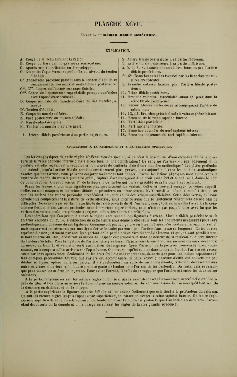 Figure 1. — Région Ubialc postérieure. EXPLICATION. A. Coupe de la peau limitant la région. B. Coupe du tissu cellulo-graisseux sous-cutané, C. Aponévrose superficielle ou d’enveloppe. C'. Coupe de l’aponévrose superficielle au niveau du tendon d’Achille. C. Aponévrose profonde passant sous le tendon d’Achille et recouvrant les vaisseaux et nerfs tibiaux postérieurs. Cw, C'. Coupes de l’aponévrose superficielle. C. w. Coupe de l’aponévrose superficielle presque confondue avec l’aponévrose profonde. D. Coupe verlicale du muscle soléaire et des muscles ju- meaux. DL Tendon d’Achille. E. Coupe du muscle soléaire. EL Face postérieure du muscle soléaire. F. Muscle plantaire grêle. F'. Tendon du muscle plantaire grêle. 1. Artère tibiale postérieure à sa partie supérieure. 2. Artère tibiale postérieure à sa partie moyenne. 3. Artère tibiale postérieure à sa partie inférieure. 4. 5, C, 7, 8. Branches musculaires fournies par l’artère tibiale postérieure. 6', 6. Branches cutanées fournies par les branches muscu- laires précédentes. 9. Branche cutanée fournie par l’artère tibiale posté- rieure. 10. Veine tibiale postérieure. 11. Branche veineuse musculaire allant se jeter dans la veine tibiale postérieure. 12. Veines tibiales postérieures accompagnant l’artère du même nom. 13. 13,13. Branches principalesdela veinesaphèneinterne. 14. Branche de la veine saphène interne. 15. Nerf tibial postérieur. 16. Nerf saphène interne. 17. Branches cutanées du nerf saphène interne. 18. Branches moyennes du nerf saphène interne. APPLICATIONS A LA PATHOLOGIE ET A LA MÉDECINE OPÉRATOIRE. Les lésions physiques de cette région n’offrent rien de spécial, si ce n’est la possibilité d’une complication de la bles- sure de la veine saphène interne ; mais est-ce bien là une complication? Le sang ne s’arrête-t-il pas facilement et la phlébite est-elle réellement à redouter si l'on a soin de traiter la plaie d’une manière méthodique? Les plaies profondes qui iraient jusqu’à l’artère tibiale seraient certainement plus graves, mais aujourd’hui, avec les notions anatomiques exactes que nous avons, nous pouvons conjurer facilement tout danger. Parmi les lésions physiques nous signalerons la rupture du tendon du muscle plantaire grêle, rupture s’accompagnant d’un bruit assez fort et auquel on a donné le nom de coup de fouet. On peut voir en F' de la figure 1 ce tendon qui par sa gracilité se prête bien à cet accident. Parmi les lésions vitales nous signalerons plus spécialement les varice;. Celles-ci peuvent occuper les veines superfi- cielles ou sous-cutanées et les veines tibiales et péronières en même temps. M. Verneuil a môme cherché à démontrer que les varices des veines profondes précédaient toujours celles des veines superficielles. Cette découverte, qui nous dévoile plus complètement la nature de cette affection, nous montre aussi que le traitement rencontrera encore plus de difficultés. Nous avons pu vérifier l’exactitude de la découverte de M. Verneuil, mais, tout en admetlant avec lui la coïn- cidence fréquente des varices profondes avec les varices superficielles, nous n’irions pas jusqu’à dire avec lui que les varices des veines profondes précèdent toujours celles des veines superficielles. Les opérations que l’on pratique sur cette région sont surtout des ligatures d’artère. Ainsi la tibiale postérieure se lie en trois endroits (1, 2, 3). L’inspection de cette figure nous donne à elle seule tous les documents nécessaires pour faire méthodiquement chacune de ces ligatures. Commençons par la ligature au tiers inférieur, c’est-à-dire au niveau du trait 3 ; mais auparavent représentons par une ligne fictive le trajet parcouru par l’artère dans toute sa longueur. Ce trajet sera représenté assez justement par une ligne partant de la partie postérieure du condyle interne et qui, suivant parallèlement le bord interne du tibia, aboutirait au milieu de l’espace compris entre le bord postérieur de la malléole et le bord interne du tendon d’Achille. Pour la ligature de l’artère tibiale au tiers inférieur nous ferons donc une incision qui aura son centre au niveau du trait 3, et aura environ 6 centimètres de longueur. Après l’incision de la peau on trouvera le fascia sous- cutané, on le coupera et l’on arrivera sur l’aponévrose. Cn peut voir qu’ici comme dans toute son étendue l’arlère est recou- verte par deux aponévroses. Seulement ici les deux feuillets sont rapprochés, de sorte que pour les inciser séparément il faut quelques précautions. On voit que l’artère est accompagnée de deux veines ; chacune d’elles est souvent un peu dilatée et hypertrophiée dans ses parois. Il y a quelquefois, par suite de ces changements, tellement de ressemblance entre les veines et l’artère, qu’il faut se prendre garde de tomber dans l’erreur de les confondre. Du reste, cela se remar- que pour toutes les artères de la jambe. Pour éviter l’erreur, il suffît de se rappeler que l’artère est entre les deux autres vaisseaux. A la partie moyenne on suit les mêmes règles qu’en bas. Après avoir découvert l’aponévrose superficielle on l’incise près du tibia et l’on porte cn arrière le bord interne du muscle soléaire. On voit au-dessous le vaisseau qu’il faut lier. On le découvre en dédolunt et on le charge. A la partie supérieure la ligature est très difficile et l’on devine facilement que cela tient à la profondeur du vaisseau. On suit les mêmes règles jusqu’à l’aponévrose superficielle, en évitant de blesser la veine saphène interne. On incise l’apo- névrose superficielle et le muscle soléaire. On tombe alors sur l'aponévrose profonde que l’on incise en dédolant. L’artère étant découverte on la dénude et on la charge en suivant les règles de lapins grande prudence.