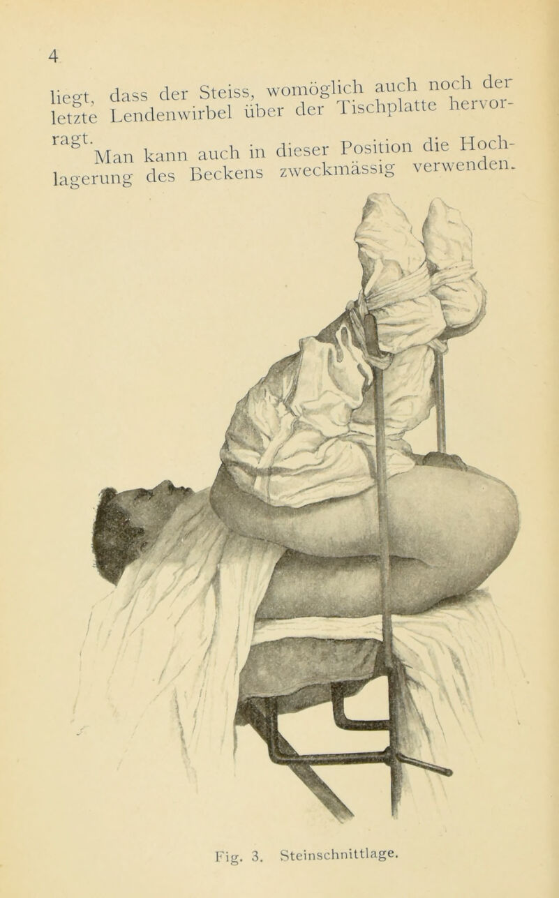 liegt, letzte dass der Steiss, womoglich auch noch dei Lendenwirbel uber der Tischplatte hervor- ragt. . Man kann auch m lagerung des Beckens dieser Position die Hoch zweckmassig verwenden. Fig. 3. Steinschnittlage.