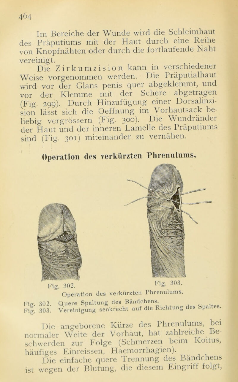 Im Bereiche der Wunde wird die Schleimhaut des Praputiums mit der Haut durch eine Reihe von Knopfnahten oder durch die fortlaufende Nalrt vereinigt. Die Zirkumzision kann in verschiedener Weise vorgenommen werden. Die Praputialhaut wird vor der Gians penis cpier abgeklemmt, und vor der Klemme mit der Schere abgetiagen (Fig- 299). Durch Hinzufiigung einer Dorsalinzi- sion lasst sich die Oeffnung im Vorhautsack be- liebig vergrossern (Fig. 3°°)- Die ^ undrandei der Haut und der inneren Lamelle des Praputiums sind (Fig. 301) miteinander zu vernahen. Operation des verkiirzten Phrenulums. Fig. 302 Fig. 303. Operation des verkiirzten Phrenulums. Fie. 302. Quere Spaltung des Biindchens. P'ig. 303. Vereinigung senkrecht auf die Richtung des Spa Die angeborene Kiirze des Phrenulums, bei normaler Weite der Vorhaut, hat zahlreiche Be- schwerden zur Folge (Schmerzen beim Koitus, haufiges Einrcissen, Haemorrhagien). Die einfache quere I rcnnung des Bandchcns ist wegen der Blutung, die diesem Eingriff folgt,