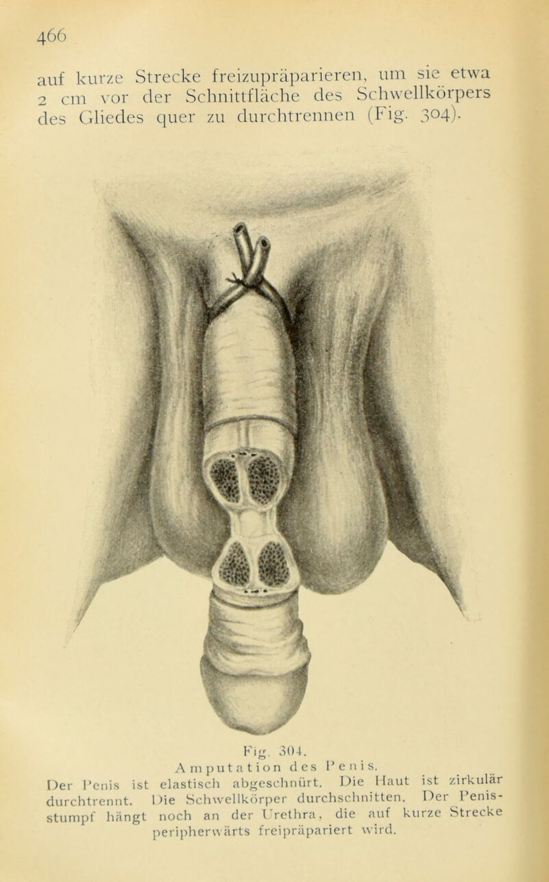 auf kurze Strecke freizupraparieren, um sie etwa 2 cm vor der Schnittflache des Schwellkorpers des Gliedes quer zu durchtrennen (Fig. 3°4)- Fig. 304. Amputation des Penis. Der Penis ist elastisch abgeschniirt. Die Haut ist zirkular durchtrennt. Die Schwellkorper durchschnitten. Der Penis- stumpf hiingt noch an der Frethra, die auf kurze Stiecke peripherwarts freiprapariert wird.