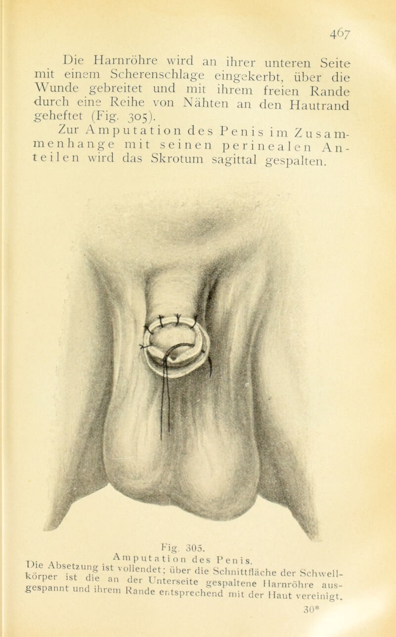 Die Harnrohre wird an ihrer unteren Seite mit einem Scherenschlage eingekerbt, liber die Wunde gebreitet und mit ihrem freien Rande durch eine Reihe von Nahten an den Hautrand geheftet (Fig. 305). Zur Amputation d e s Penis im Zusam- m enhange mit seinen perine a len An- te i 1 e n wird das Skrotum sagittal gespalten. t ig. 305. Tv „ Amputation des Penis kdrper Tst2Udif 1St V°allenc^t; iibet' die Schnittflache der Schwell- eesnannt und U, a ,?er ,Unterseite gespaltene Harnrohre aus- g I und ihiem Rande entsprechend mit der Haut vereinigt. 30*