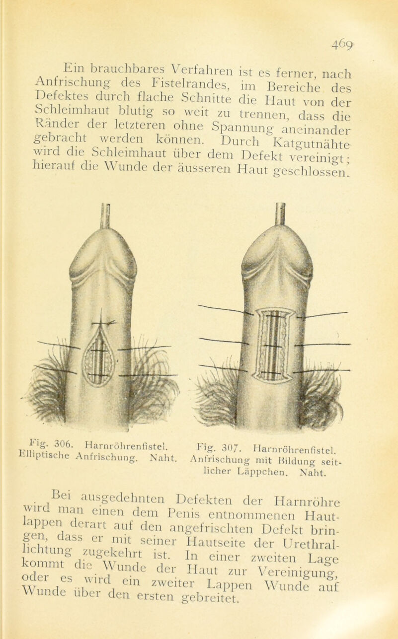 Ein brauchbares Verfahren ist es ferner nach Anfrischung des FisteJrandes, im Bereiche des Defektes durch flache Schnitte die Haul von der Schleimhaut blutig so weit zu trennen, class die Randcr der letzteren ohne Spannung aneinander gebracht werclen konnen. Durch Katgutnahte wird die Schleimhaut iiber dem Defekt vereinigt; nerauf die \\ unde der ausseren Haut geschlossen. I ig. 306. Harnrohrenfistei. klliptische Anfrischung. Naht. I'ig. 30/. Harnrohrenfistei. Anfrischung mit Hildung sei licher Lappchen. Naht. • ,Bei ausgedehnten Defekten der Harnrohre Zl* * ***a ma,n einen dem Pcnis entnommenen Haut- *** Cerart auf clen angefrischten Defekt brin- fchiunfJ1' i1111/ seiner Hautseite der Urethral- kommt^rli^w611,1 lst In eiller zweiten Lage oder es A. 1 Undc der ppaut zur Vercinigung, Wunde iiberVl Cm zweiter happen Wundc auf rincic ubei den ersten gebreitet.