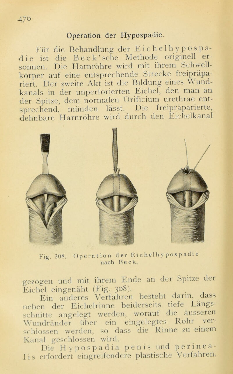 Operation der Hypospadie. Fiir die Behandlung der E i c h c 1 h y p o s p a- die ist die Beck’sche Methode originell er- sonnen. Die Harnrohre wird mit ihrem Schwell- korper auf eine entsprechende Strecke freiprapa- riert. Der zweite Akt ist die Bildung eines \\ und- kanals in der unperforierten Eichel, den man an der Spitze, deni normalen Orificiuni urethiae ent- sprechend, miinden lasst. Die freipi aparierte, delinbare Harnrohre wird durch den Eic lielkanal Fig. 308. Operation der E i chelhv pos p adi e nach Heck. gezogen und mit ihrem Ende an dei Spitze der Eichel eingenaht (Fig. 308). Ein anderes Verfahren besteht dann, dass neben der Eichelnnne beiderseits tiefe Ecings- schnitte angclegt werden, worauf die ausscren Wundrander liber ein eingelegtcs Roln ver- schlossen werden, so dass die Rhine zu einem Kanal geschlossen wird. Die Hypospadia p e n i s und perinea- 1 i s erfordert eingreifendere plastische Verfahren.