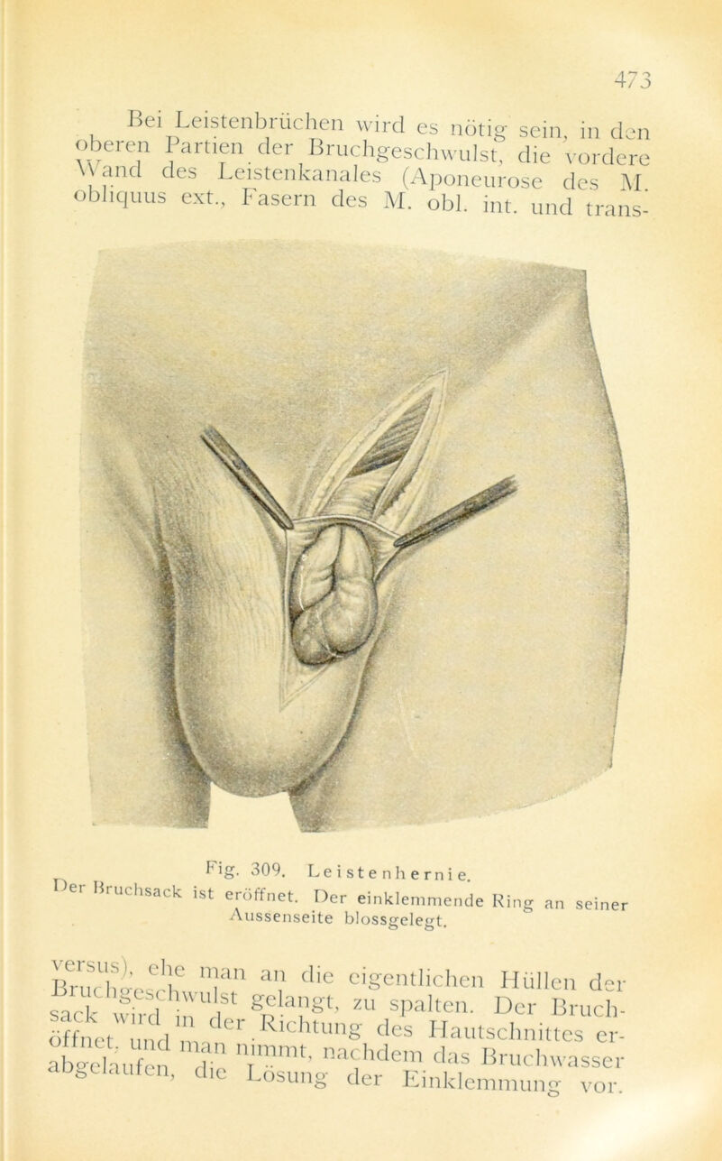 Bei Leistenbruchen wird es notig sein, in den oberen Partien der Bruchgeschwulst. die vordere \ and des Leistenkanales (Aponeurose des M obliquus ext., Fasern des M. obi. int. und nans- Fig- 309. Leistenhernie. er HrUChsack ist ertffneF Der einklemmende Ring an seiner Aussenseite blossgelegt. Brut ii<rnsr , }d al! die el&entlichen Hullen der sad- wird h a gdailgt< zu sPalten- Der Bruch- dffL und mndei‘ RlChtUng des Hautschnittes er- ab'Telaufcn din nr'nimt' na' hdem das Bruchwasser gt tauten, die Losung der Einklemmung vor.