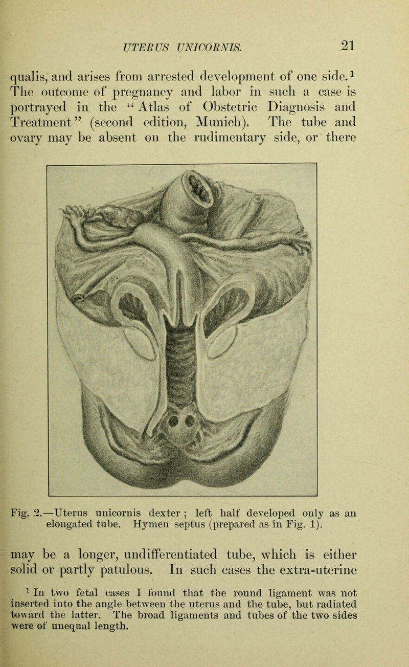 qualis, and arises from arrested development of one side.1 The outcome of pregnancy and labor in such a case is portrayed in the “ Atlas of Obstetric Diagnosis and Treatment” (second edition, Munich). The tube and ovary may be absent on the rudimentary side, or there Fig. 2.—Uterus unicornis dexter ; left half developed only as an elongated tube. Hymen septus (prepared as in Fig. 1). may be a longer, undifferentiated tube, which is either solid or partly patulous. In such cases the extra-uterine 1 In two fetal cases I found that the round ligament was not inserted into the angle between the uterus and the tube, but radiated toward the latter. The broad ligaments and tubes of the two sides were of unequal length.