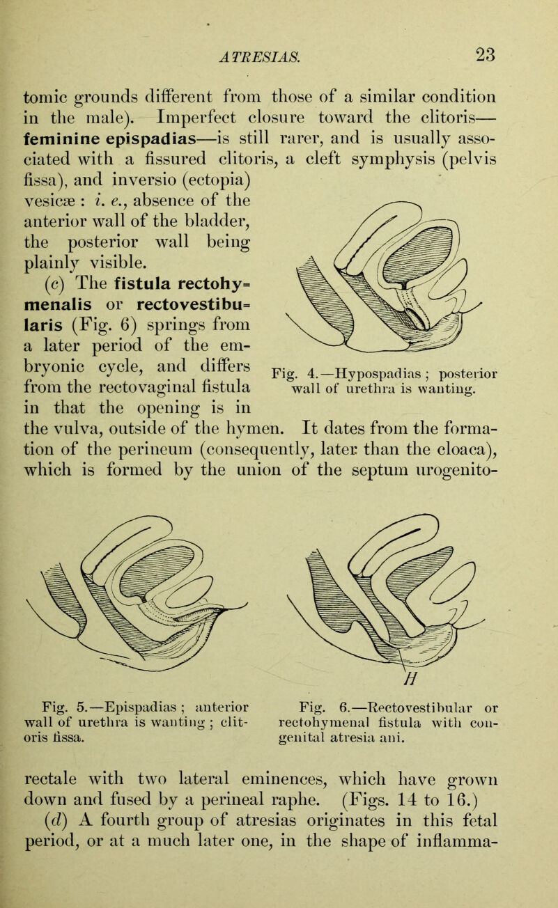 tomic grounds different from those of a similar condition in the male). Imperfect closure toward the clitoris— feminine epispadias—is still rarer, and is usually asso- ciated with a fissured clitor fissa), and inversio (ectopia) vesicse : i. e., absence of the anterior wall of the bladder, the posterior wall being plainly visible. (c) The fistula rectohy= menalis or rectovestibu= laris (Fig. 6) springs from a later period of the em- bryonic cycle, and differs from the rectovaginal fistula s, a cleft symphysis (pelvis Fig. 4.—Hypospadias ; posterior wall of urethra is wanting. in that the opening is in the vulva, outside of the hymen. It dates from the forma- tion of the perineum (consequently, later than the cloaca), which is formed by the union of the septum urogenito- Fig. 5.—Epispadias ; anterior wall of urethra is wanting ; clit- oris fissa. Fig. 6.—Rectovestibular or rectohymenal fistula with con- genital atresia ani. rectale with two lateral eminences, which have grown down and fused by a perineal raphe. (Figs. 14 to 16.) (d) A fourth group of atresias originates in this fetal period, or at a much later one, in the shape of inflamma-