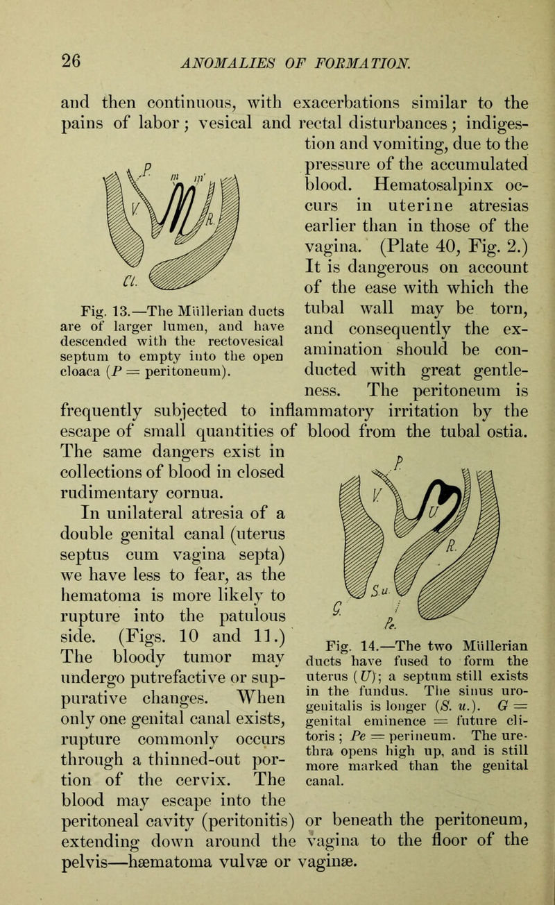 and then continuous, with exacerbations similar to the pains of labor; vesical and rectal disturbances; indiges- tion and vomiting, due to the pressure of the accumulated blood. Hematosalpinx oc- curs in uterine atresias earlier than in those of the vagina. (Plate 40, Fig. 2.) It is dangerous on account of the ease with which the tubal wall may be torn, and consequently the ex- amination should be con- ducted with great gentle- ness. The peritoneum is frequently subjected to inflammatory irritation by the escape of small quantities of blood from the tubal ostia. The same dangers exist in collections of blood in closed rudimentary cornua. In unilateral atresia of a double genital canal (uterus septus cum vagina septa) we have less to fear, as the hematoma is more likely to rupture into the patulous side. (Figs. 10 and 11.) The bloody tumor may undergo putrefactive or sup- purative changes. When only one genital canal exists, rupture commonly occurs through a thinned-out por- tion of the cervix. The blood may escape into the peritoneal cavity (peritonitis) extending down around the vagina to the floor of the pelvis—hsematoma vulvae or vaginae. Fig. 14.—The two Müllerian ducts have fused to form the uterus (£7); a septum still exists in the fundus. The sinus uro- genitalis is longer (S. u.). G = genital eminence = future cli- toris ; Pe — perineum. The ure- thra opens high up, and is still more marked than the genital canal. or beneath the peritoneum, Fig. 13.—The Müllerian ducts are of larger lumen, and have descended with the rectovesical septum to empty into the open cloaca (P = peritoneum).