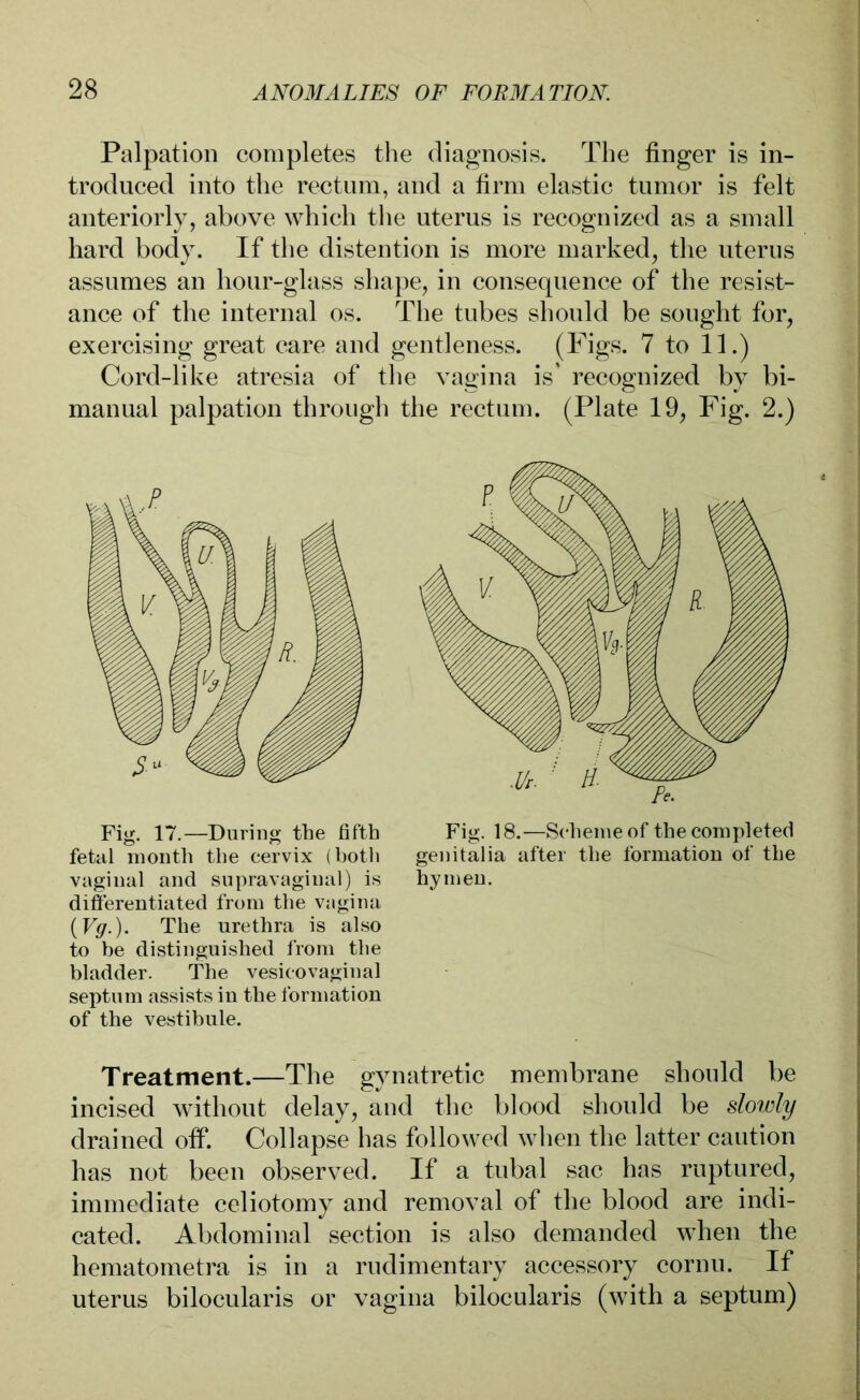 Palpation completes the diagnosis, The finger is in- troduced into the rectum, and a firm elastic tumor is felt anteriorly, above which the uterus is recognized as a small hard body. If the distention is more marked, the uterus assumes an hour-glass shape, in consequence of the resist- ance of the internal os. The tubes should be sought for, exercising great care and gentleness. (Figs- 7 to 11.) Cord-like atresia of the vagina is' recognized by bi- manual palpation through the rectum. (Plate 19, Fig. 2.) Fig. 17.—Daring the fifth fetal month the cervix (both vaginal and supravaginal) is differentiated from the vagina (Vg.). The urethra is also to be distinguished from the bladder. The vesicovaginal septum assists in the formation of the vestibule. Fig. 18.—Scheme of the completed genitalia after the formation of the hymen. Treatment.—The gvnatretic membrane should be incised without delay, and the blood should be slowly drained off. Collapse has followed when the latter caution has not been observed. If a tubal sac has ruptured, immediate celiotomy and removal of the blood are indi- cated. Abdominal section is also demanded when the hematometra is in a rudimentary accessory cornu. If uterus bilocularis or vagina bilocularis (with a septum)