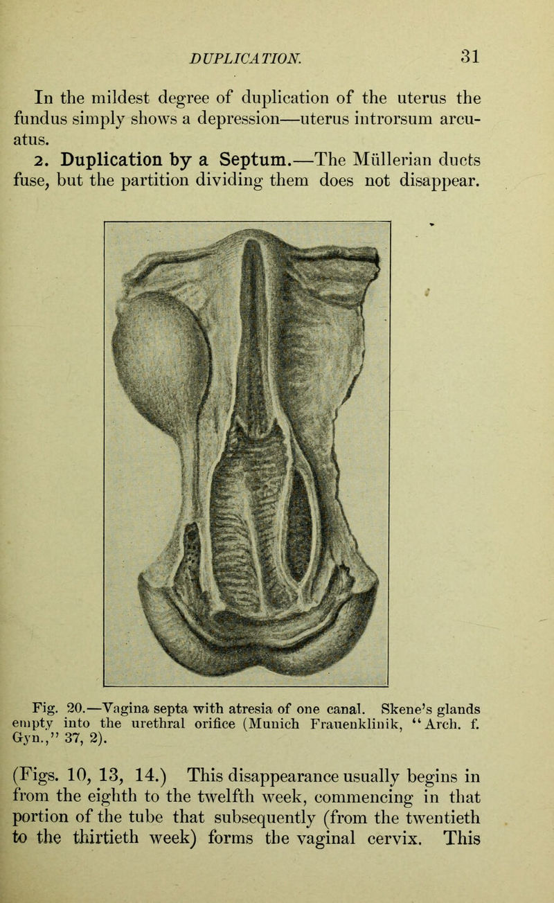 In the mildest degree of duplication of the uterus the fundus simply shows a depression—uterus introrsum arcu- atus. 2. Duplication by a Septum.—The Müllerian ducts fuse, but the partition dividing them does not disappear. Fig. 20.—Vagina septa with atresia of one canal. Skene’s glands empty into the urethral orifice (Munich Frauenklinik, “Arch. f. Gyn.,” 37, 2). (Figs. 10, 13, 14.) This disappearance usually begins in from the eighth to the twelfth week, commencing in that portion of the tube that subsequently (from the twentieth to the thirtieth week) forms the vaginal cervix. This